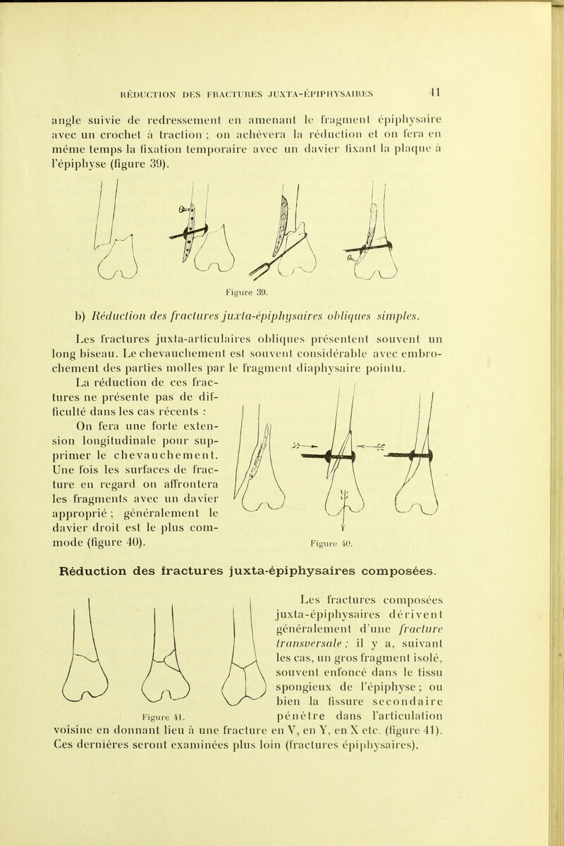 angle suivie de redressement en amenant le tVagment epiphysaire avec un crochet a traction ; on achevera la reduction et on fera en meme temps la fixation temporaire avec un davier lixant la plaque a I'epiphyse (figure 39). Figure 39. b) Reduction des froctiircs juxia-epiphysaires obliques simples. Les fractures juxta-articulaires obliques presentent souvent un long biseau. Le chevauchement est souvent considerable avec embro- chement des parties molles par le fragment diaphysaire pointu. La reduction de ces frac- tures ne presente pas de dif- ficulte dans les cas recents : On fera une forte exten- sion longitudinale pour sup- primer le chevauchement. Une fois les surfaces de frac- ture en regard on affrontera les fragments avec un davier approprie ; generalement le davier droit est le plus com- mode (figure 40). Figure 40. Reduction des fractures juxta-epiphysaires composees. Les fractures composees juxta-epiphysaires derivent generalement d'une fracture Iransversale: il y a, suivant les cas, un gros fragment isole, souvent enfonce dans le tissu spongieux de I'epiphyse; ou bien la fissure secondaire Figure 41. penetre dans I'articulation voisine en donnant lieu a une fracture en V, en Y, en X etc. (figure 41). Ces dernieres seront examinees plus loin (fractures epiphysaires).