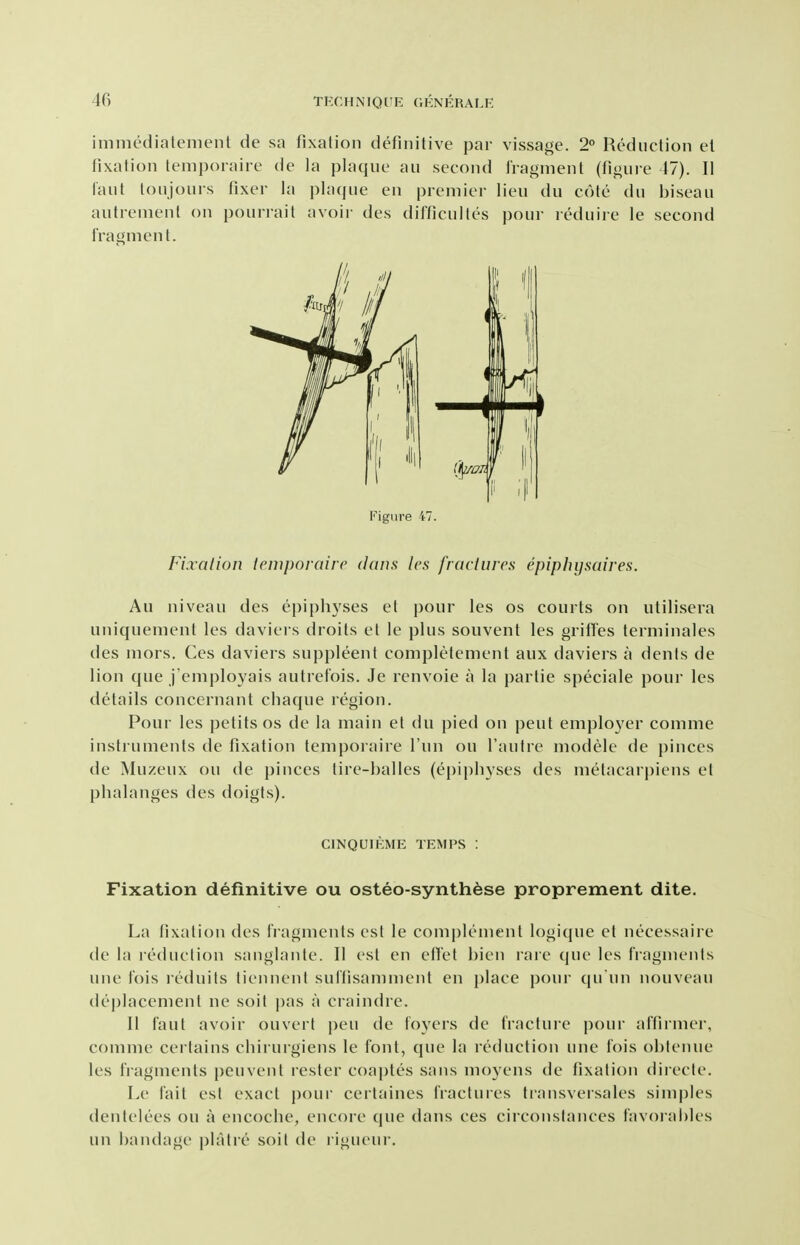 immediatement de sa fixation definitive par vissage. 2° Reduction el fixation lemporaire de la plaque au second iragment (figure 47). II laut loujours fixer la plaque en premier lieu du cote du biseau autrenienl on pourrait avoir des difficulles pour reduire le second fragment. Figure 47. Fixation lemporaire dans les fraetures epiphysaires. Au niveau des epiph3'ses et pour les os courts on utilisera uniquement les daviers droits et le plus souvent les griffes terminales des mors. Ces daviers suppleent completement aux daviers a denis de lion que j'employais autrefois. Je renvoie a la partie speciale pour les details concernant chaque region. Pour les petits os de la main et du pied on pent employer comme instruments de fixation lemporaire I'un on I'autre modele de pinces de Muzeux ou de pinces tire-balles (epiphyses des metacarpiens et phalanges des doigts). CINQUIKME TEMPS : Fixation definitive ou osteo-synthese proprement dite. La fixation des fragments est le complement logique et necessaire de la reduction sanglante. II est en elTet hien rare que les fragments ime Ibis leduits tiennent sulfisamment en i)lace pour qu un iiouveau dej)lacenient ne soil |)as a craindre. 11 faul avoir ouverl pen de foyers de fracture pour affirmer, comme certains chirurgiens le font, que la reduction une fois ohlenue les fragments {)euvenl rester coaptes sans moyens de fixation diiecle. Le fait est exact pour cerlaines fractures transversales simples dentelees ou a encoche, encore (pie dans ces circonstances favoi al)les iin bandage platie soil de rigiieur.