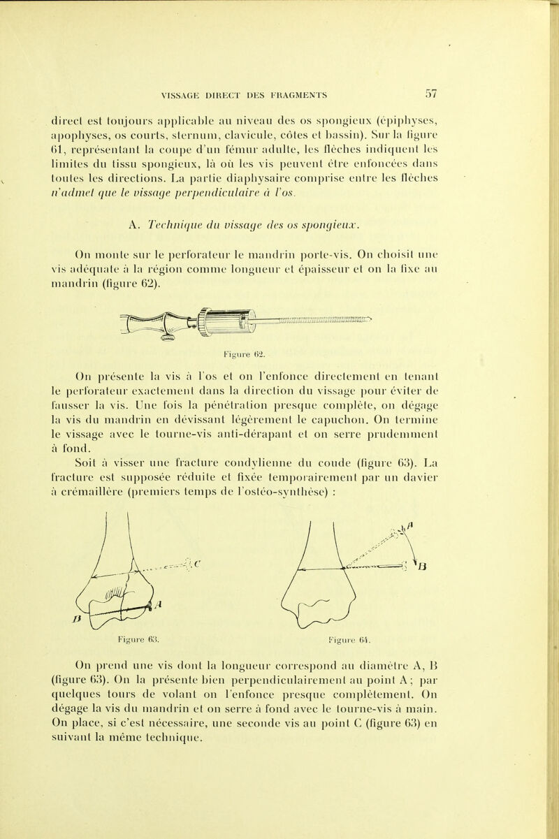 direct est toujoui-s applicnl)le au niveau des os spongieiix (epiphyses, apophyses, os courts, sternum, chivicule, cotes et Ijassin). Snr ht ligure representant hi coupe d'un femur adulte, les Heches indiquent les liniites du tissu spongieux, la ou les vis peuvent etre enfoncees dans toutes les directions. La partie diaphysaire comprise entre les Heches nadnu't que le vissage perpendiciilaire d ios. On monte sur le perl'orateur le nKuuh in porte-vis. On clioisit uni- vis adequate a la region comme longueur et epaisseur et on la lixe au mandrin (figure 62). On presente la vis a Tos et on rent'once directemenl en tenant le perl'orateur exactenient dans la direction du vissage pour eviter de I'ausser la vis. Une I'ois la penetration presque comj)lete, on degage la vis du mandrin en devissant legerement le capuchon. On termine le vissage avec le tourne-vis anti-derapant et on serre prudemment a fond. Soil a visser une fracture condylienne du coude (figure 63). La fracture est supposee reduite et fixee temporairement par un davier a cremaillere (premiers temps de I'osteo-synthese) : On prend une vis dont la longueur correspond au diametre A, B (figure 63). On la presente hien perpendiculairement au point A; par quelques tours de volant on I'enfonce presque completement. On degage la vis du mandrin et on serre a fond avec le tourne-vis a main. On place, si c'est necessaire, une seconde vis au point C (figure 63) en suivant la meme technique. A. Technique du vissage des os spongieux. mmmmmmmmmcy Figure
