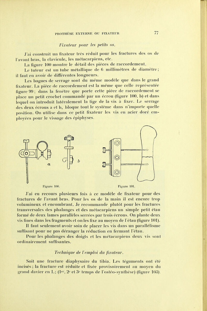 Fixaieur pour Ics petUs os. J'ni coiislniit un fixateur ties rediiit pour les fractures Hes os de ravanl l)ras, la clavicule, les melacarpiens, etc. La figure 100 montre le dcMail des pieces de raccordement. Le tuteur est uu tube metallique de 6 millimetres de diameire; il faut en avoir de differentes lougueurs. Les bagues de serrage scut dii menie modele que daus le grand fixateur. La piece de raccordement est la meme que celle representee figure 99; dans la fenetre que porte cetle piece de raccordement se place un petit crochet commande par un ecrou (figure 100, b) et dans lequel on introduit lateralement la tige de la vis a fixer. Le serrage des deux ecrous a et b, bloque tout le systeme dans n'importe quelle position. On utilise dans ce petit fixateur les vis en acier dore em- ployees pour le vissage des epiphyses. .T'ai eu recours plusieurs fois a ce modele de fixateur pour des fractures de I'avant bras. Pour les os de la main il est encore trop volumineux et encombrant. Je recommande plutot pour les fractures transversales des phalanges et des metacarpiens un simple petit etau forme de deux lames paralleles serrees par trois ecrous. On plante deux vis fines dans les fragments et on les fixe au moyen de I'etau (figure 101). II faut seulement avoir soin de placer les vis dans un parallelisme suffisant i)our ne pas deranger la reduction en fermant I'etau. Pour les phalanges des doigts et les nielacaipiens deux vis soni ordinairement suffisantes. Soit une fracture diaphysaire du tibia. Les teguments out ete incises ; la fracture est reduite et fixee provisoirement au moyen du grand davier en L; (l*-' , 2^ et 3^ temps de I'osleo-synthese) (figure lOo). Figure IDO. Figure 101. Technique de leniploi du fixateur.