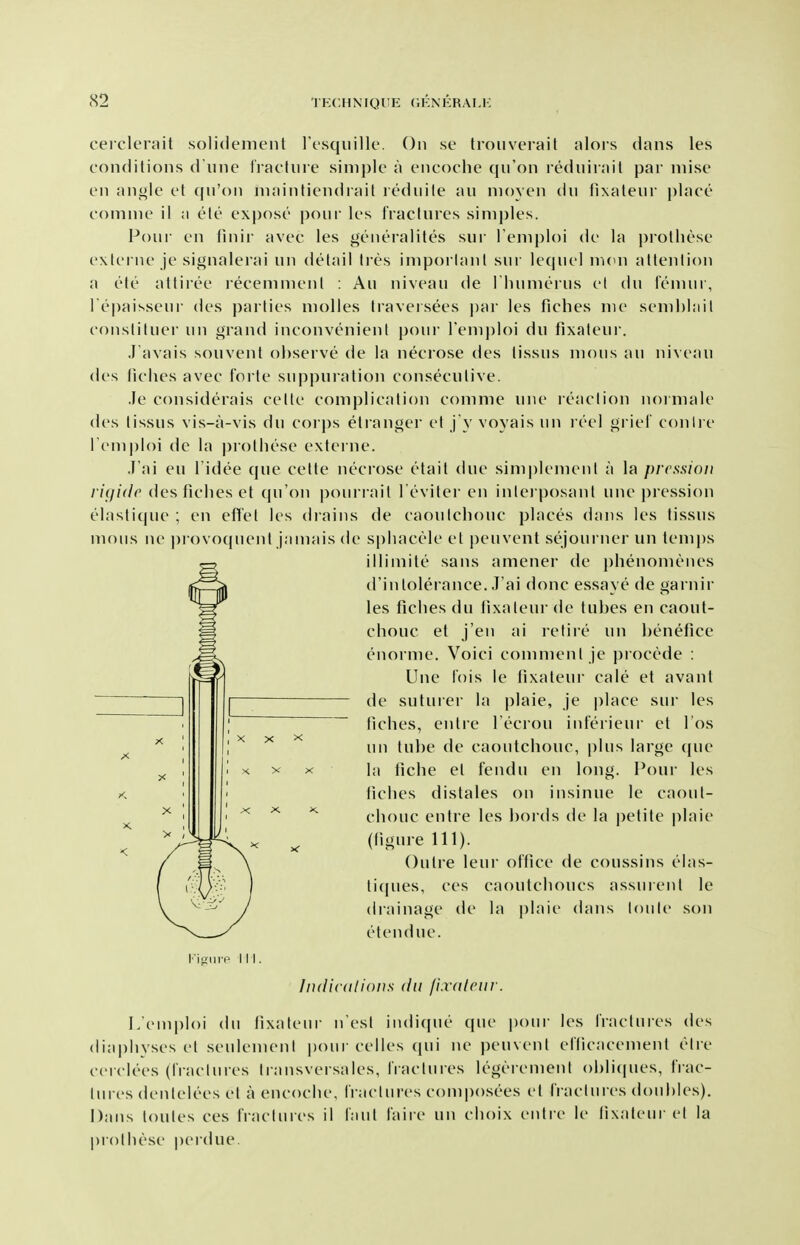 cerclenut solidement I't'vsqiiille. On se troiiverail alors dans les conditions d une IVactnre sinii)lc a cncoche qu'on rediiiiail par niise en ani>lc vi ([n'on niainlicMidiaK it'diiile an nioyen dn fixaleur })lace comnie il a ete expose' j)oni' les fractures simples. Pour en linir avec les generalites sur l eniploi de la prolhese exlerne je signalerai un detail Ires iniporlanl sur leqnel nKui altenlion a ete attiree receninienl : An nivean de l linnierns el dn femur, l epaisseur des parties molles traversees par les fiches me semhhiil consliluei' un graiul inconvenient [)our I'emploi du fixateur. J avais souvenl observe de la neciose des tissus mous an niveau des liches avec forte suppuration consecutive. Je considerais cetle complication comme uiie reaction normale des tissus vis-a-vis du corps etianger et j y voyais un reel grief conlre Femploi de la |)rothese externe. J'ai eu I'idee que celte necrose etait due simpleiuent a la prcssiou ri<ji(lc desficlieset (|u'on ponrrait I'eviler en inlei posaul une pression elasti(pie ; en efl'el les diains de caoutchouc places dans les tissus mous ne piovotjuenl jamais de sphacele et penvent sc\journer un temps illimite sans ameuer de phenomeues d'iutolerance. J'ai done essaye de gariiir les ficlies du lixaleur de tubes en caout- chouc et j'en ai retire un benefice enorme. Voici comment je j)rocede : Une fois le tixateur cale et avant de suturer la plaie, je place sui- les tiches, entre I'ecrou inferieur et I'os un tube de caoutchouc, plus large que la fiche et fendu en long. Pour les liches distales on insinue le caout- chouc entre les bords de la |)etite plaie (figure 111). Outre leui- oftice de coussins elas- ticpies, ces caoutchoucs assurenl le drainage de la plaie dans loule son etendue. l''ioiirP 111. Indicitlious du fi.vdlcui-. Lemploi du tixalenr n est indicpie que ponr les fractures des diaphyses et seulemenl ponr celles qui ne peuvenl eflicacement elre cerclees (fractures Iransversales, fractures legeremenl obli(|ues, frac- tures dentelees et a encoche, fractures composees el fraclures doubles), Dans loules ces fiachires il laul faii e un choix entre le lixatenr el la prolhese perdue.