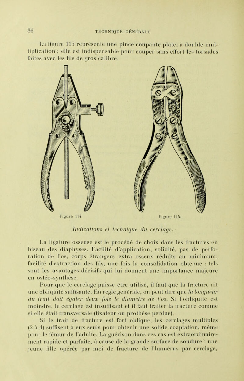 La figure 115 represenlc iine pince coupaiite ])lale, a double mul- liplicalion; elle est iudispeusa])le pour couper sans eliorl les lorsades failes avec les lils de gros ealibre. Indicdlions el technique dii cerclage. La ligaluie osseuse est le j)rocede de choix daus les I'raetures en biseau des diapliyses. Facilite d'applicatiou, solidite, pas de perfo- ration de I'os, eorps elrangers extra osseux rednits au niininunn, facilite d'exlraetion des tils, une fois la eonsolidalion oblenue : iels sont les avantages tieeisifs qui lui dounent uue ini|)orlanee majeure en osteo-syntliese. Pour que le cerclage puisse elre utilise, 11 faut (pie la IVaeture ail ULie obli(|uite suffisanle. Vm regie generale, on |)eul dire que hi loiujiK'iir (ill Iruil doit egalef deux fuis le diameiie de I'os. Si i'oljliquile est nioindre, le cerclage est insuflisant el il faul tiailer la fracture comnie si elle etait transversale (fixateur on prothese perdue). Si le trait de fracluie est fort oblique, les cerclages multiples (2 a 1) suffisent a eux seuls i)our obtenir une solide coaptation, meme pour le femur de I'adulte. La guerison dans ces cas est extraordinaire- menl lapide et parfaite, a cause de la grande surface de soudure : une jeune lille oj)eree par moi de fracture de riuimerus par cerclage,