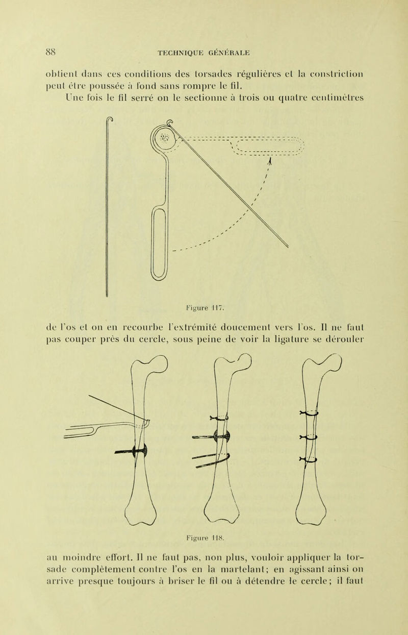 ohticnl thins ccs coiulilioiis des toisadcs regiilierus cl la (.oiislriiiioii peiil cHrc poiissee a loiui sans lomprc le fil. Une I'ois le fil sene on le sectionne a trois on qiialie ceiilinielies Figure 117. de I'os et on en lecourbe l extiemite doneenienl vers I'os. II ne I'aiil pas eouper pres du cercle, sous peine de voir la ligature se derouler Figure IIS, au moindre ellorl. II ne taul pas, non j)lus, vouloir appliquei' la tor- sade completement conlre I'os en la niarlelant; en agissant ainsi on arrive presque toujours a hriser le fil on a detendre le cercle; 11 taut