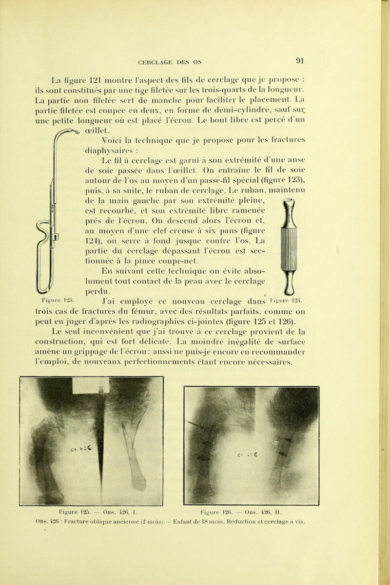 La ligurc 121 monlre I'aspect des fils de cerclage que je propose : ils soiU constitiies j)ar line lige filetee siir les trois-qiiarts de la longueur. La partie non filetee sert de nianche pour laciliter le placement. La pai tie liletee est coupee en deux, en lornie de demi-cylindre, saui sur une petite longueur ou est place Tecrou. Le bout libre est perce d un CKillet. Voici la technique que je propose pour les fractures diaphysaires : Le fil a cerclage est garni a son exlremite d'une anse de sole passee dans rccillet. On entraine le fil de soie autour de I'os an nioyen d'un passe-lil special (figure 123), puis, a sa suite, le ruhan de cerclage. Le ruban, maintenu de la main gauche par son extremite pleine, est recourbe, et son extremite libre ramenee pres de Teciou. On descend alois I'ecrou et, an moyen d'une del creuse a six pans (figure 124), on serre a fond jusque contre I'os. La partie du cerclage depassant I'ecrou est sec- tionnee a la pince coupe-net. En suivant cette technique on evite abso- ij lument tout contact de la peau avec le cerclage perdu. Figure 123. j'^i employe ce nouveau cerclage dans ligure I2'i. trois cas de fractures du femur, avec des resultats parfaits, comme on peut en juger d'apres les radiographics ci-jointes (figure 125 et 126). Le seul inconvenient que j'ai trouve a ce cerclage provient de la construction, (pii est fort delicate. La moindre inegalite de surface amene un grippage de I'ecrou ; aussi ne puis-je encore en recommander reni|)loi, de nouveaux perfectionnements etant encore necessaires. Figure 125. — Obs. Wd, I, Obs. 426 : Fracture oljliijue ancieiine (2 iiiois) Figure I2(i. — Ubs. 42(5, 11. Eut'ant de 18 inuis. Reduction et cerclage a vis.