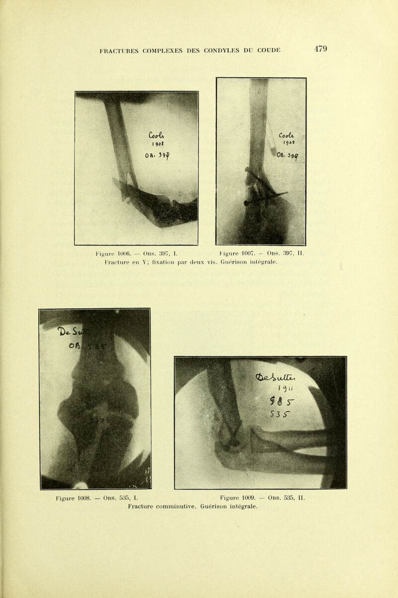 igure 1008. — Obs. 535, I. Figure 1009. - Fracture comminutive. Guerison integrale. Obs. 535, IL