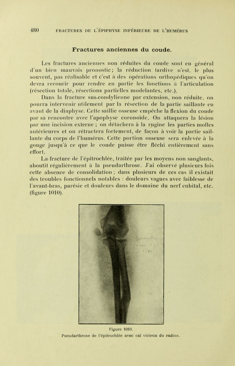 Fractures anciennes du coude. Les fracUiies anciennes non reduites du coude sonl en eneral d'un hien niauvais pronostic; la reduclion lardive n'esl, le plus souvent, pas realisable et c'est a des operations orlliO|)ediques qu'on devra lecourir pour rendre en parlie les I'onctions a Tarticulation (resection lotale, resections partiellcs niodelantes, etc.). Dans la fracture sus-condylienne par extension, non reduite, on pourra intervenir iitilenienl par la resection de la partie saillanle en avant de la diaphyse. Celte saillie osseuse enipeclie la flexion du coude par sa rencontre avec l'apoj)liyse coronoide. On attaquera la lesion par une incision exlerne ; on delacliera a la rugine les parties niolles anterieures et on relractera fortement, de facon a voii- la pailie sail- lante du corps de riuimerus. Ce[[e portion osseuse sera enlevee a la gouge jusqu'a ce que le coude puisse etre flechi entieremenl sans effort. La-fracture de I'epitrochlee, traitee par les moyens non sanglanls, aboutit regulierement a la pseudarthrose. J'ai observe pkisieurs fois celte absence de consolidation ; dans plusieurs de ces cas il existail des troubles fonctionnels notables : douleurs vagues avec faiblesse de I'avant-bras, paresie et douleurs dans le domaine du nerf cubital, etc. (figure 1010). Figure 1010. Pseudarthrose de I'epitrochlee avec cat vicieux du radius.