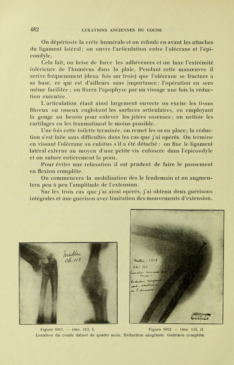 On deperiosfe la crete humerale et on refoule en avant les attaches du ligament lateral; on ouvre I'arliculation enti e I'olecrane el I'epi- condyle. Cela fait, on brise de force les adherences et on luxe I'extremite iiiferieure de riuimerus dans la plaie. Pendant cette manoeuvre il arrive frequemment (deux fois sur trois) que Tolecrane se fracture a sa base, ce qui est d'ailleurs sans importance; I'operation en sera ineme facilitee ; on fixera I'apophyse par un vissage une fois la reduc- tion execulee. L'articulation elant ainsi largement ouverte on excise les tissus fibreux ou osseux englobant les surfaces articulaires, en employant la gouge au besoin pour enlever les jetees osseuses; on netfoie les cartilages en les traumatisant le moins possible. Une fois cette toilette terminee, on remet les os en place; la reduc- tion s'est faite sans difficultes dans les cas que j'ai operes. On terniine en vissant I'olecrane au cubitus s'il a ele detacbe ; on fixe le ligament lateral externe au moyen d une petite vis enfoncee dans I'epicondyle et on suture entierement la peau. Pour eviter une reluxation il est prudent de faire le pansement en flexion complete. On commencera la mobilisation des le lendemain et on augmen- tera peu a pen I'amplitude de I'extension. Sur les trois cas que j'ai ainsi operes, j'ai obfenu deux guerisons integrates et une guerison avec limitation des mouvements d'extension. Figure lUI I. - Obs. 113, 1. Figure 1012. — Obs. 113, 11. Luxation du coude dalant de quatre mois. Reduction sanglante. Uuerison complete.