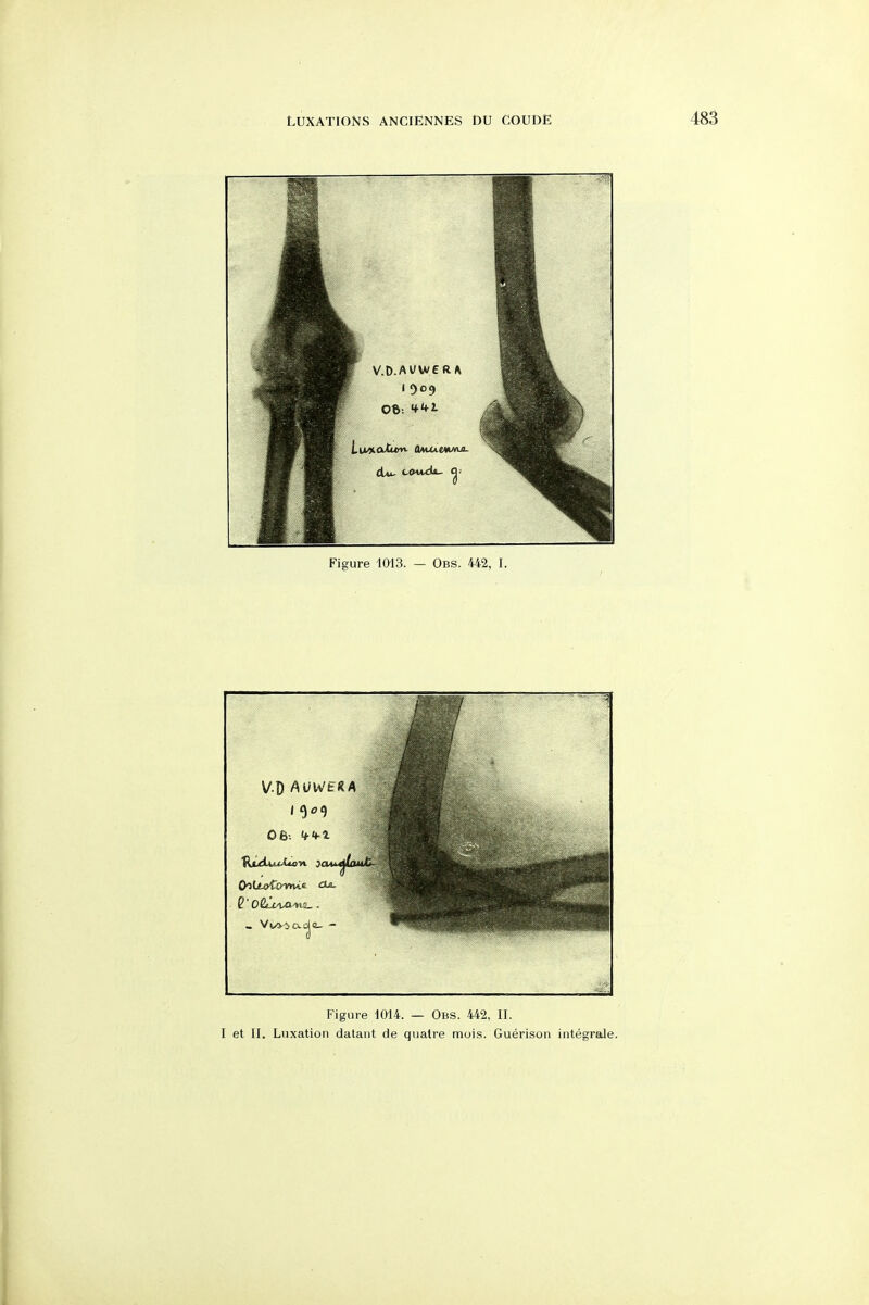 Figure 1014. — Obs. 442, II. I et II. Luxation datant de quatre mois. Guerison integrale.