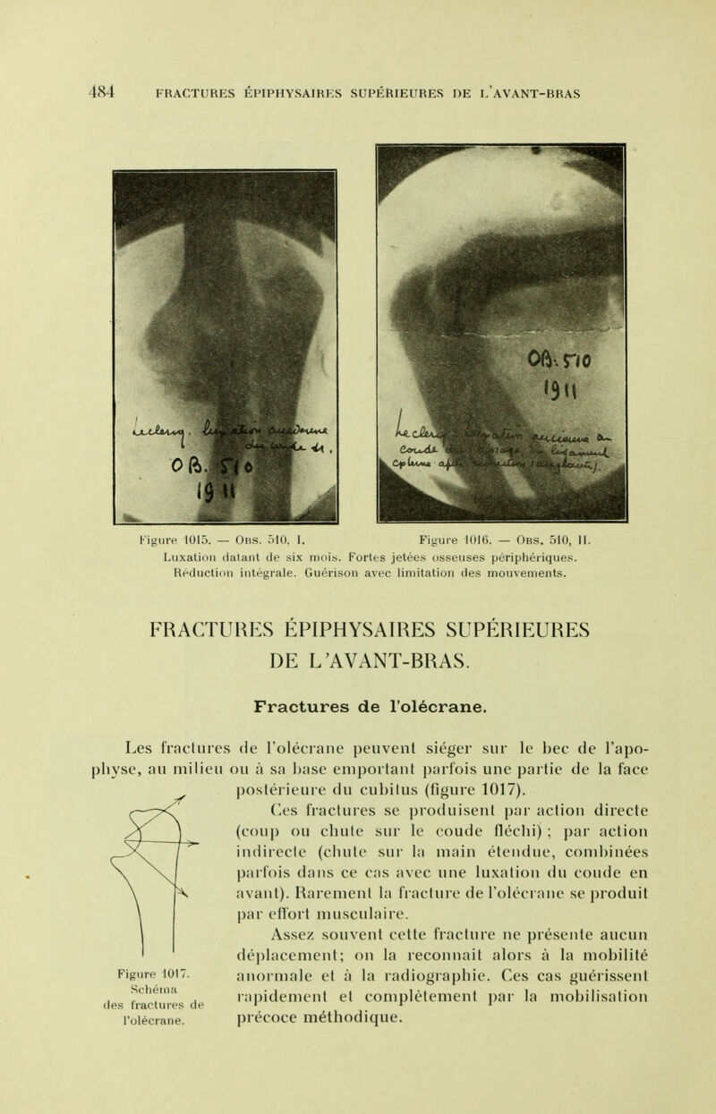 Figure 1015. — Obs. 510, I. Figure lOIG. — Obs. 510, II. Luxation dataiit de six mois. Fortes jetees osseuses peripheriques. Reduction inteorale. Guerison avec limitation des mouvements. FRACTURES EPIPHYSAIRES SUPERIEURES DE L'AVANT-BRAS. Fractures de I'ol^crane. Les fratiiires de I'oleciaiie peiivenl sieger siir le bee cle I'apo- pliyse, ail milieu ou a sa l)ase emportant parfois une partie de la face posterieure du cubitus (figure 1017). (k'.s fractures se produisenl par action directc (coup ou cluite sur le coude flechi) ; par action indirecte (clnile sui- la main eteudue, combiuees parfois dans ce cas avec une luxation du coude en avant). Raremenl la fracture derolecraue se jiroduit par effort musculaire. Assez souvent cette fracture ne presente aucun deplacement; on la reconnail alors a la mobilite Figure 1017. auormale et a la radiograpbie. Ces cas guerissent Schema rapidenieut el completement i)ar la mobilisation des fractures de ' r i roiecrane. precocc mcthodique.