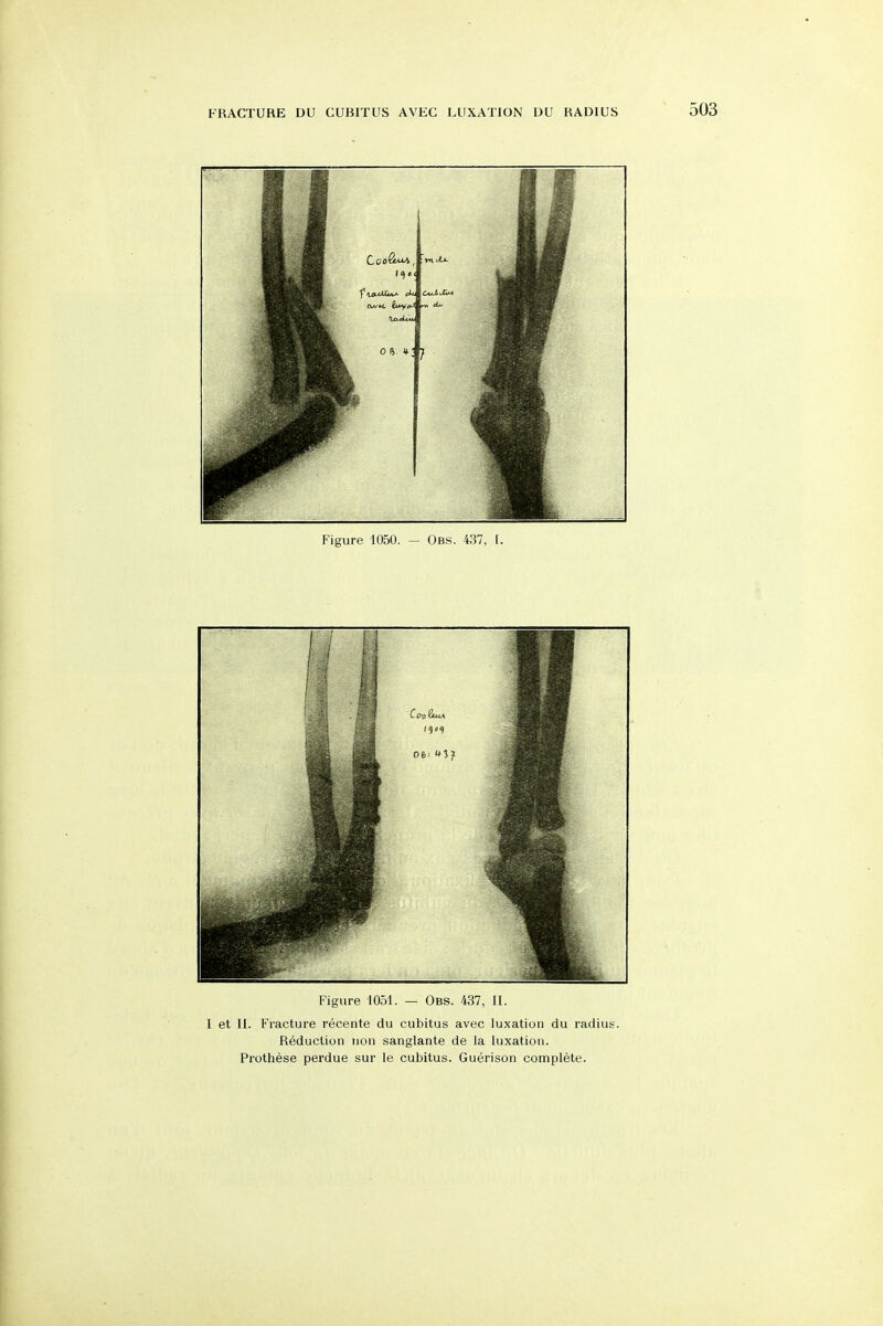 Figure 1050. - Obs. 437, [. Figure 1051. — Obs. 437, II. I et II. Fracture recente du cubitus avec luxation du radius. Reduction uon sanglante de la luxation. Prothese perdue sur le cubitus. Guerison complete.
