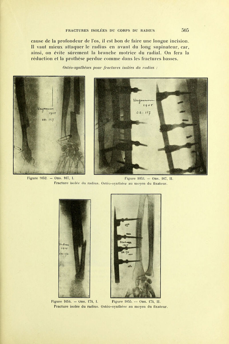 cause de la profondeur de I'os, il est bon de faire une longue incision. II vaut mieux attaquer le radius en avant du long supinateur, car, ainsi, on evite surement la branche motrice du radial. On fera la reduction et la prothese perdue comme dans les fractures basses. Osteosyntheses pour fractures isolees du rudius : Figure 1052. — Obs. 167, I. Figure 1053. — Obs. 1(57, II. Fracture isolee du radius. Osteo-synthese au moyen du fixateur. Figure 1054. — Obs. 174, I. Figure 1055. — Obs. 174, II. Fracture isolee du radius. Osteo-synthese au moyen du fixateur.