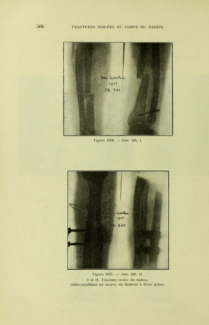 Figure 1056. — Obs. '200, I. Figure 1057. — Obs. 200, II. I et II. Fracture isolee du radius. Osteo-synthese au moyen du fixateur a deux fiches.