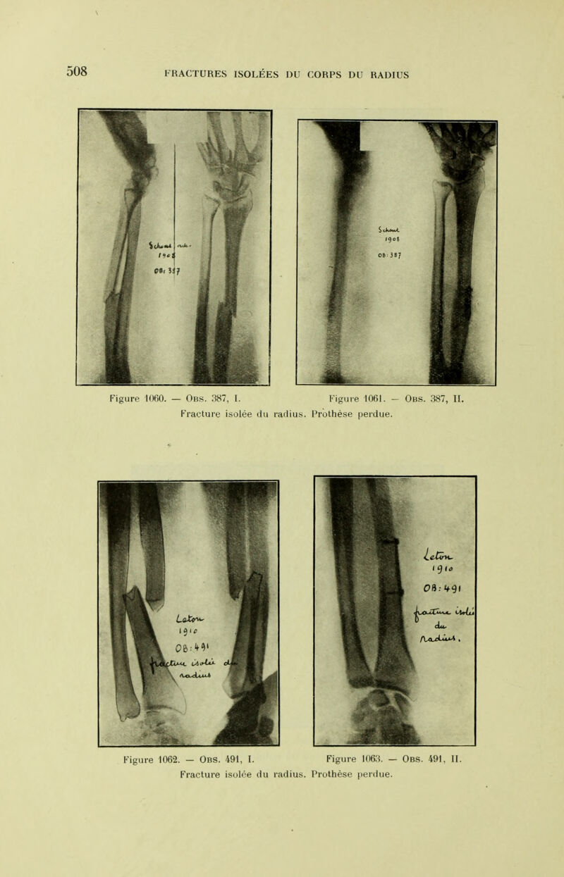 \ Kigure 1062. — Obs. 491, I. Figure l(l6:i. — Obs. 491, II. Fracture isolee du radius. Prothese perdue.