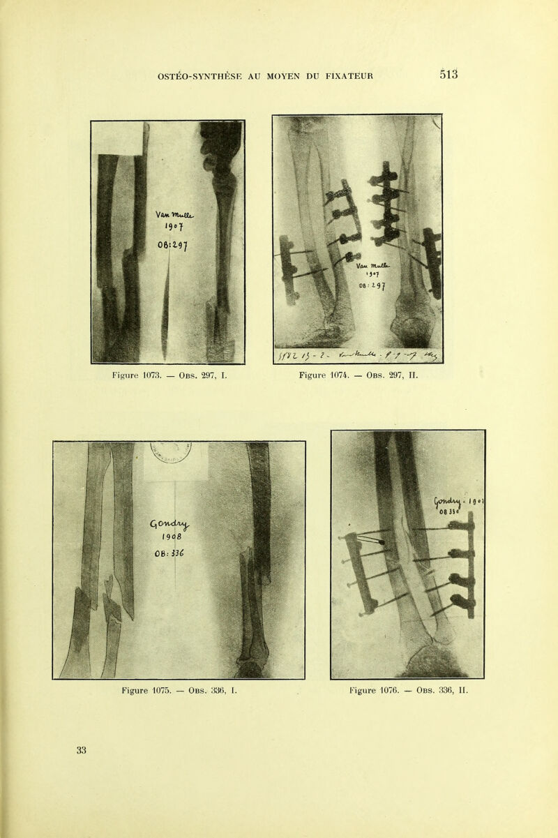 OSTEO-SYNTHESE AU MOYEN DU FIXATEUR 51^ Figure 1073. — Obs. 297, I. Figure 1074. — Obs. 297, II. 33