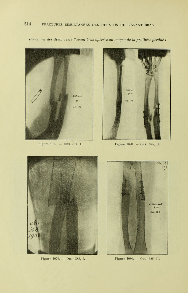 Fractures des deiix os de I'avant-bras operees an moijeii de la prothese perdue :