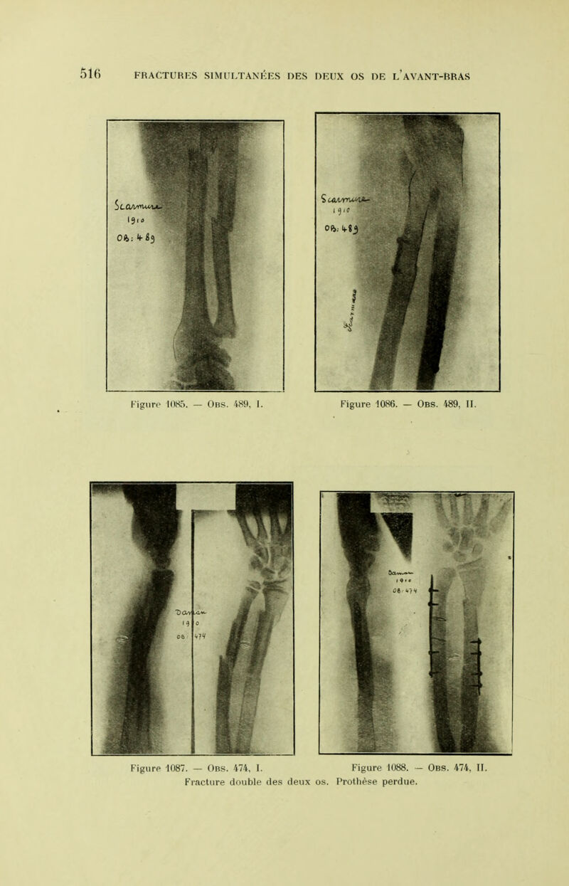 Figure 1087. — Obs. 474, I. Figure 1088. - Obs. 474. II. Fracture double des deux os. Prothese perdue.