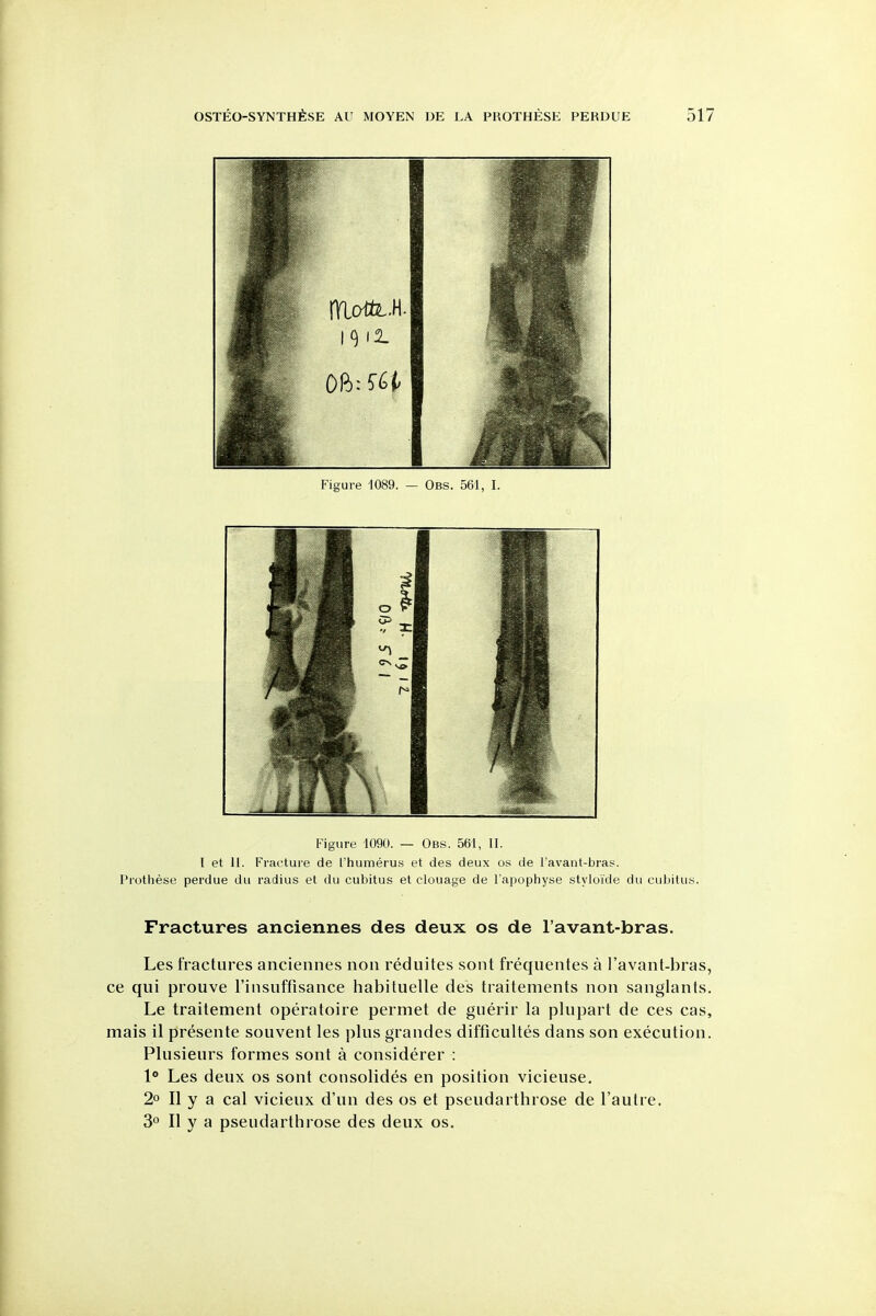 Figure 1089. — Obs. 561, I. Figure 1090. — Obs. 561, II. I et II. Fracture de I'humerus et des deux os de I'avant-bras. Prothese perdue du radius et du cubitus et clouage de I'apophyse styloide du cubitus. Fractures anciennes des deux os de I'avant-bras. Les fractures anciennes non reduites sont frequentes a I'avant-bras, ce qui prouve I'insuffisance liabituelle des traitements non sanglants. Le traitement operatoire permet de guerir la plupart de ces cas, mais il presente souvent les j)lus grandes difficultes dans son execution. Plusieurs formes sont a considerer : 1° Les deux os sont consolides en position vicieuse. 2o II y a cal vicieux d'un des os et pseudarthrose de I'autre. 3° II y a pseudarthrose des deux os.