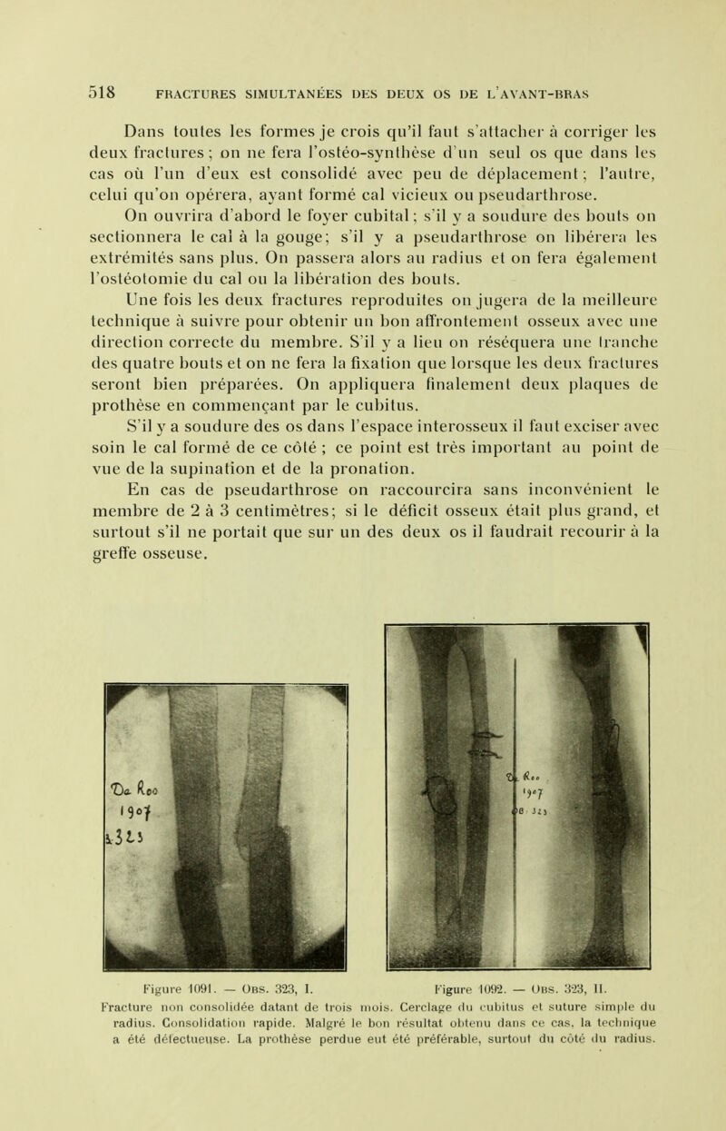 Dans toutes les formes je crois qu'il faut s'attacher a corriger les deux fractures ; on ne fera I'osteo-synlhese d un seul os que dans les cas oil Tun d'eux est consolide avec pen de deplacement; I'autre, celui qu'on operera, ayant forme cal vicieux ou pseudarthrose. On ouvrira d'abord le foyer cubital; s'il y a soudure des bouts on sectionnera le cai a la gouge; s'il y a pseudarthrose on libererii les extremites sans plus. On passera alors au radius et on fera egalenient I'osteotomie du cal ou la liberation des bouts. Une fois les deux fractures reproduites on jugera de la meilleure technique a suivre pour obtenir un bon affrontement osseux avec une direction correcte du membre. S'il y a lieu on resequera une tranche des quatre bouts et on ne fera la fixation que lorsque les deux fractures seront bien preparees. On appliquera finalement deux plaques de prothese en commencant par le cubitus. S'il y a soudure des os dans I'espace interosseux il faut exciser avec soin le cal forme de ce cole ; ce point est tres important au point de vue de la supination et de la pronation. En cas de pseudarthrose on raccourcira sans inconvenient le membre de 2 a 3 centimetres; si le deficit osseux etait plus grand, et surtout s'il ne portait que sur un des deux os il faudrait recourir a la greffe osseuse. Figure 1091. — Obs. 323, I. Figure 1092. — Obs. 323, II. Fracture non consolidee datant de trois niois. Cerclage du cubitus et suture sim|)le du radiu.s. Consolidation rapide. Malgre le bon resultat obtenu dans ce cas. la teciniique a ete detectueiise. La prothese pei'due eut ete preferable, surtout du cote du radius.