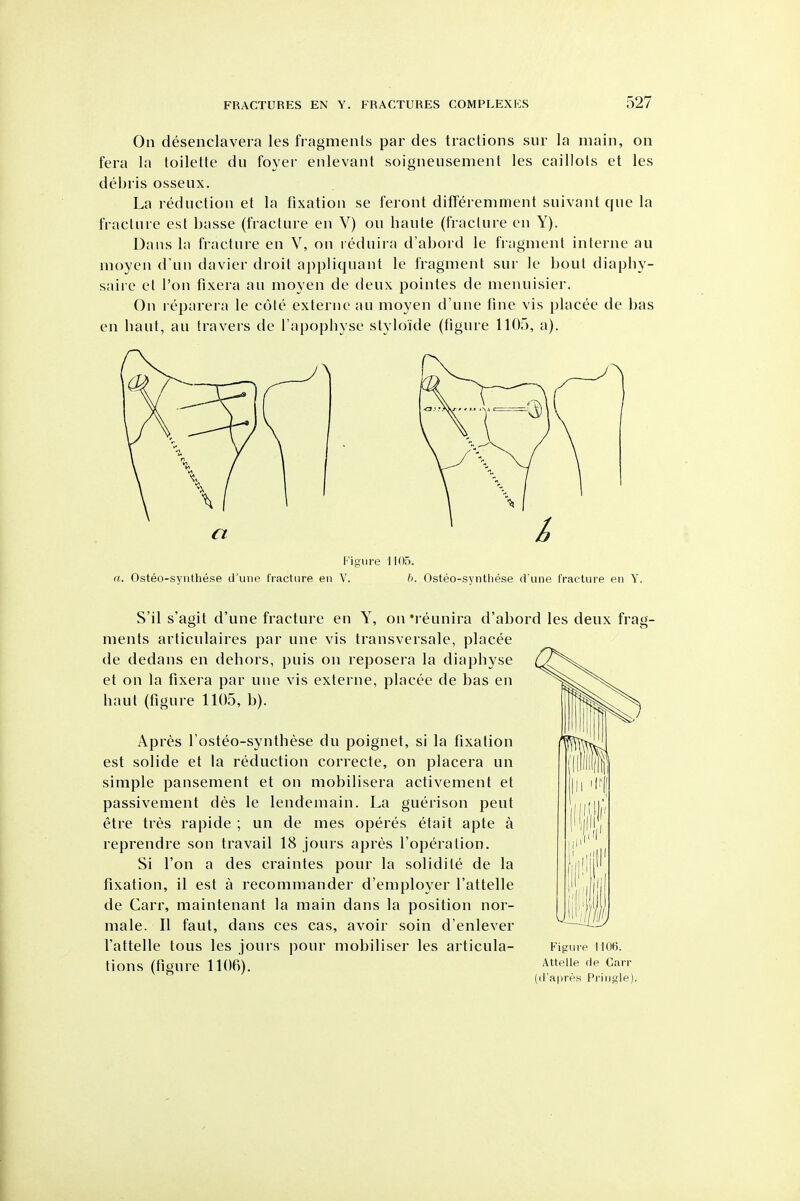 On desenclavera les fragments par des tractions sur la main, on fera la toilette du foyer enlevant soigneusement les caillots et les debris osseux. La rednction et la fixation se feront differemnient suivant qne la fracture est basse (fracture en V) on haute (fracture en Y). Dans la fracture en V, on reduira d'abord le fragment interne au moyen d'un davier droit appliquant le fragment sur le bout diaphy- saire et Ton fixera au moyen de deux pointes de menuisier. On reparera le cote externe au moyen d'une fine vis placee de bas en haul, au travers de I'apophyse styloide (figure 1105, a). Figure 1105. a. Osteo-synthese d'une fracture en V. h. Osteo-syntliese d'une fracture en Y. S'il s'agit d'une fracture en Y, on 'reunira d'abord les deux frag- ments articulaires par une vis transversale, placee de dedans en dehors, puis on reposera la diaphyse et on la fixera par une vis externe, placee de bas en haut (figure 1105, b). Apres I'osteo-synthese du poignet, si la fixation est solide et la reduction correcte, on placera un simple pansement et on mobilisera activement et passivement des le lendemain. La guerison peut etre tres rapide ; un de mes operes etait apte a reprendre son travail 18 jours apres I'operalion. Si Ton a des craintes pour la solidite de la fixation, il est a recommander d'employer I'attelle de Carr, maintenant la main dans la position nor- male. II faut, dans ces cas, avoir soin d'enlever I'attelle tons les jours jiour mobiliser les articula- tions (figure 1106). Figure 1106. Attelle de Carr d'aprps Pringle).