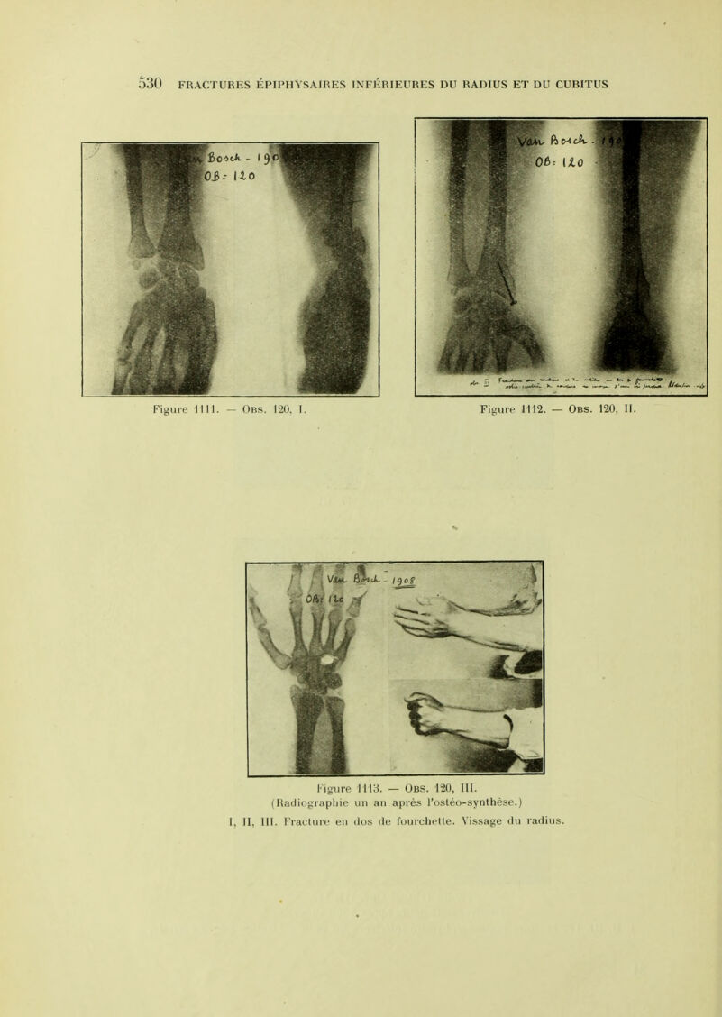 Figure 1113. — Obs. 120, III. (Hadiographie un an apres I'osleo-synthese.) I, II, 111. Fractiiie en dus de fourchctte. Vi.ssage dii radius.