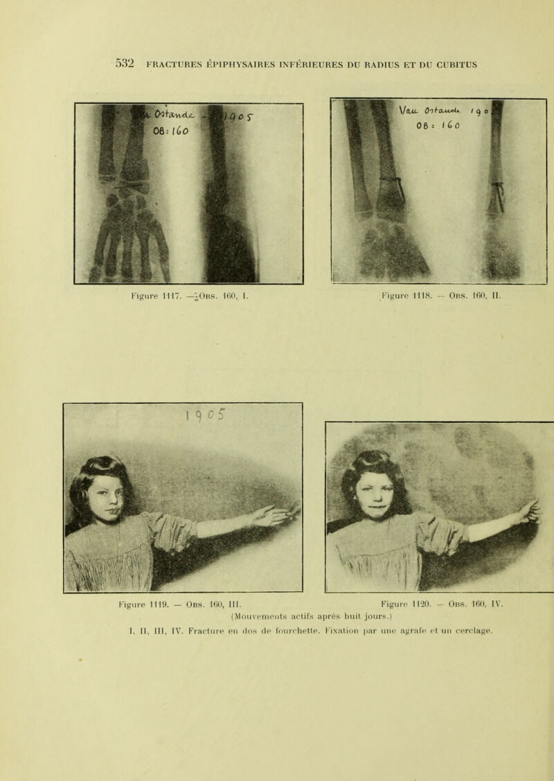 Figure 1119. — Obs. KiU, 111. I'^igmc 1120. - Obs. KiO, IV (iVIouvemeiits actif.s apres liuit jours.) 1. II, III, IV. FiaftuiP Pii ilos dp ffuiif'hettp. Kixalion pai' uiic ai^ialf el iiii cert-lage.
