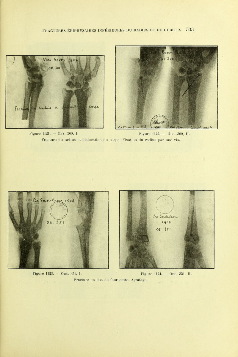 Figure 1123. — Obs. 351, I. Figure 1124. — Qua. 351, II. Fracture eii dos de fourchelte. Agrafage.