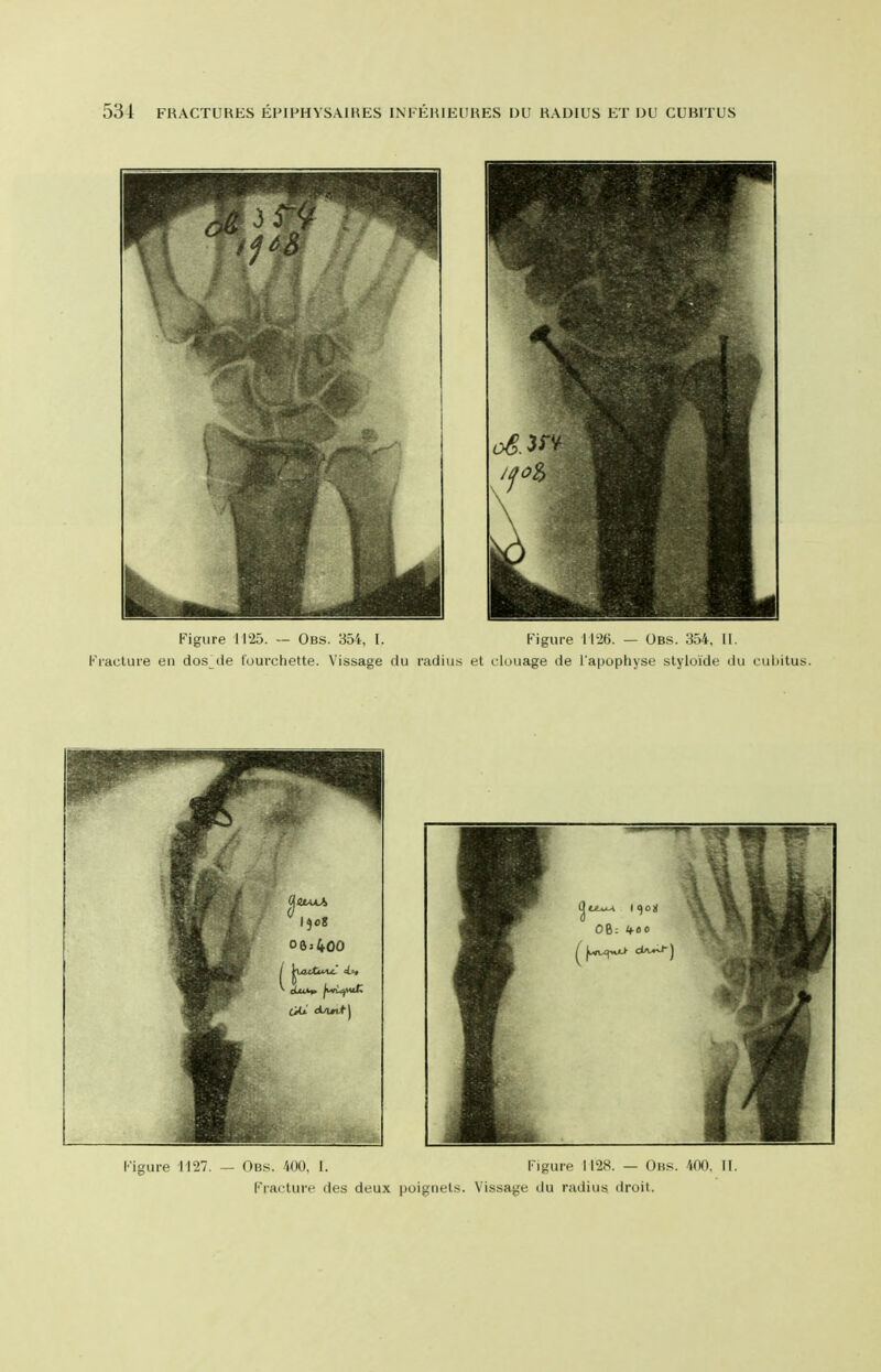 Figure 1127. — Obs. 400, I. Figure 1128. — Ons. 400, II. Fracture des deux poigiiel.s. Vissage du radius droit.