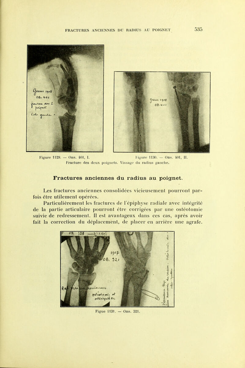 Les fractures anciennes consolidees vicieusement pourroiii par- fois etre utilement operees. Particulierement les fractures de I'epiphyse radiate avec integrite de la partie articulaire pourront etre corrigees par une osteotomie suivie de redressement. II est avantageux dans ces cas, apres avoir fait la correction du deplacement, de placer en arriere une agrafe. Figue l']31. — Obs. 321.