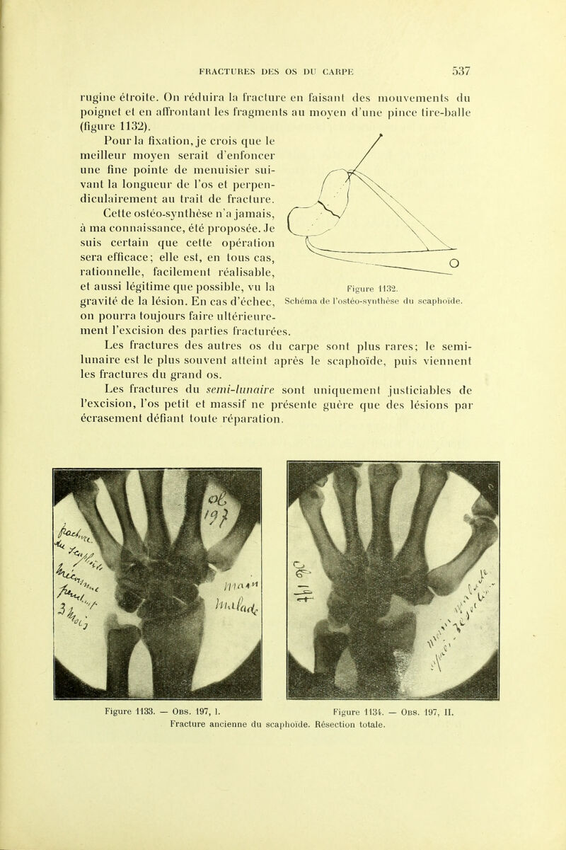 rugine etroite. On reduira la fracture en faisant des niouvements du poignet et en alFrontant les fragments au moyen d'line pince tire-balle (figure 1132). Pour la fixation, je crois que le meilleur moyen serait d'enfoncer une fine pointe de menuisier sui- vant la longueur de I'os et perpen- diculairement au trait de fracture. Cette osteo-synthese n'a jamais, a ma connaissance, ete proposee. Je suis certain que cette operation sera efficace; elle est, en tons cas, rationnelle, facilement realisable, et aussi legitime que possible, vu la gravite de la lesion. En cas d'echec, Schema de rosteo-synthese du scaphoide. on pourra toujours faire ulterieure- ment I'excision des parties fracturees. Les fractures des autres os du carpe sont plus rares; le semi- lunaire est le plus souvent atteint apres le scaphoide, puis viennent les fractures du grand os. Les fractures du semi-lunaire sont uniquement justiciables de I'excision, I'os petit et massif ne presente guere que des lesions par ecrasement defiant toute reparation. Figure 1133. — Obs. 197, 1. Figure 1134. — Obs. 197, II. Fracture ancienne du scaphoide. Resection totale.