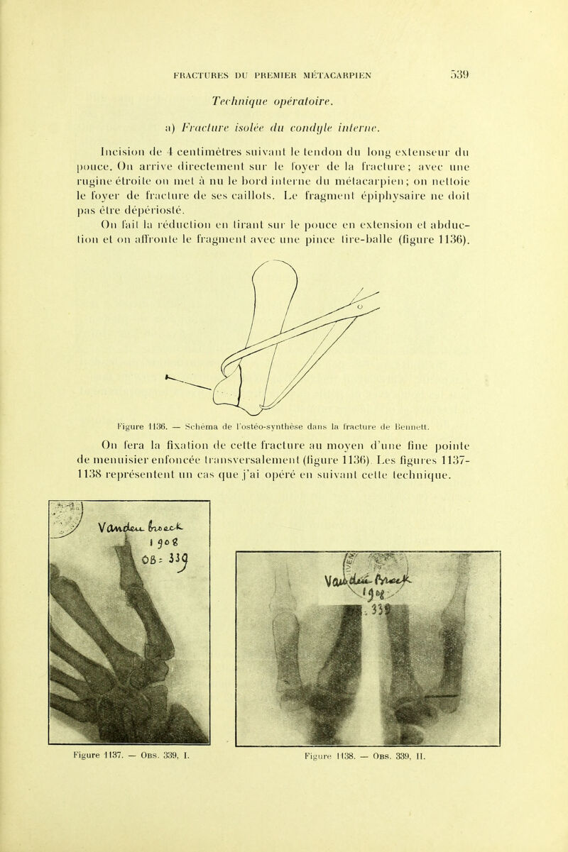 Technique operatoire. i\) Fvaclnre isolee dii condyle interne. Incision de 4 centimetres siiivant le tendon dii long exlenseur du j)()nce. On arrive directement sur le lover de la t'raeUne; avec une riigine elroile on met a nu le hord interne du metacarpien; on netloie le foyer de fraclnre de ses caillols. Le fragment epiphysaire iie doit |)as elre de})eriosle. On fail la reduction en lirant sui- le pouce en extension et abduc- tion et on aifronle le fragment avec une pince lire-balle (figure 1136). Figure 1136. — Schema de Fosteo-synthese daiiss la Iractme de lieiniett. On I'era la fixation de cette fracture au moyen d'une fine pointe de menuisier enfoncee ti ansversalement (tigure 1136). I>es figures 1137- 1138 representent un eas que j'ai opere en snivanl celle technique. Figure 1137. — Ob.s. 339. I. Figure 1138. — Obs. 339, II.