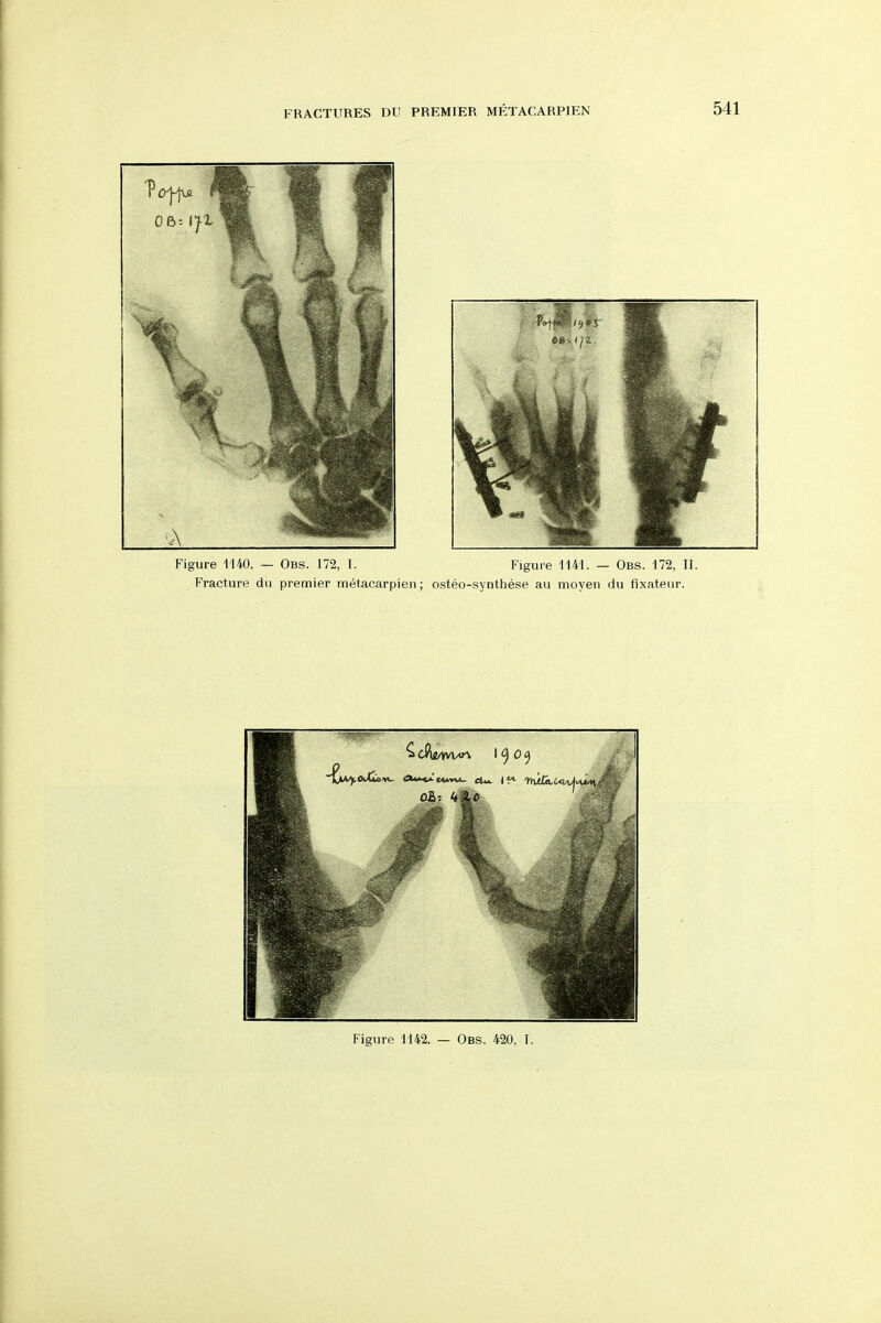 Figure 1140. — Obs. 172, 1. Figui'e 1141. — Obs. 172, II. Fracture du premier metacarpien; osteo-synthese au moyen du fixateur. Figure 1142. — Obs. 420, I.