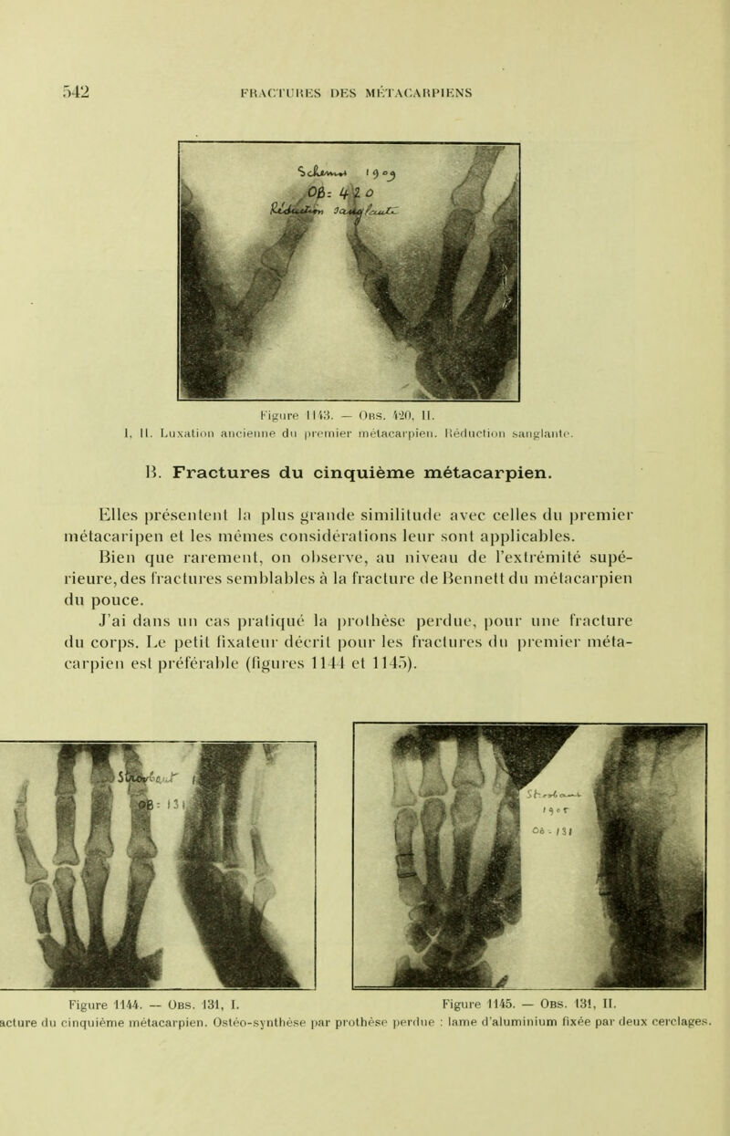 Kigm-e IIW. - Obs. m. II. 1, II. Luxation ancienne du picrnier inelacarpieii. lieductioii saiiglaiito. H. Fractures du cinquieme metacarpien. Elles preseiitent hi plus grande similitude avec celles du premier metacaripen et les memes considerations leur sont applicables. Bien que rarement, on observe, au niveau de I'extremite supe- rieure,des fractures semblables a la fracture de Bennett du metacarpien du pouce. J'ai dans un cas pratique la prothese perdue, pour une fracture du corps. Le petit fixateur decrit pour les fractures du premier meta- carpien est preferable (figures 1141 et 1145). Figure 1144. — Obs. 131, I. Figure 1145. — Obs. 13!, II. acture du cinquieme metacarpien. Osteo-synthese |)ar prothese perdue : lame d'aluminium fixee par deux reiclages.