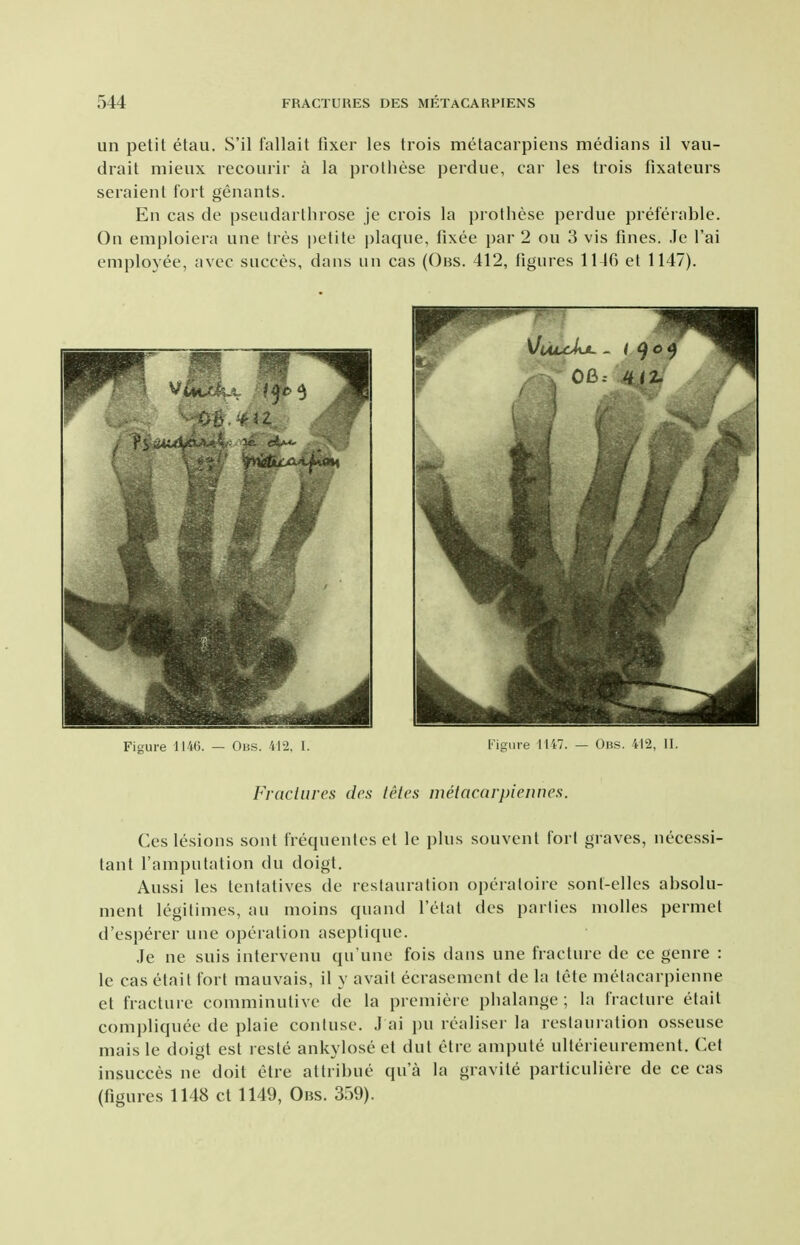 un petit etau. S'il fallait fixer les trois metacarpiens medians il vau- drait niieiix lecourir a la prothese perdue, car les trois fixateurs seraient fort genants. En cas de pseudarthrose je crois la prothese perdue preferable. On emploiera une tres petite plaque, fixee par 2 on 3 vis fines. Jc I'ai employee, avec succes, dans un cas (Obs. 412, figures 1146 et 1147). Figure 1140. — Obs. 412, I. Figure 1147. - Ob.s. 412, II. Fractures dcs teles metacarpiennes. Ces lesions sont frequenles el le plus souvenl fori graves, necessi- tant I'amputation du doigl. Aussi les tentatives de reslauralion operaloire sonl-elles absolu- ment legitimes, au moins quand I'etat des parlies molles permet d'esperer une operation aseptique. Je ne suis intervenu qu'une fois dans une fracture de ce genre : le cas elait fort mauvais, il y avail ecrasement de la lete metacarpienne et fracture comminutivc de la premiere phalange ; la fracture etait compliquee de plaie contuse. J ai pu realiser la restauration osseuse mais le doigt est reste ankylose et dut etre ampute ulterieurement. Cet insucces ne doit etre attribue qua la gravite particuliere de ce cas (figures 1148 ct 1149, Obs. 359).