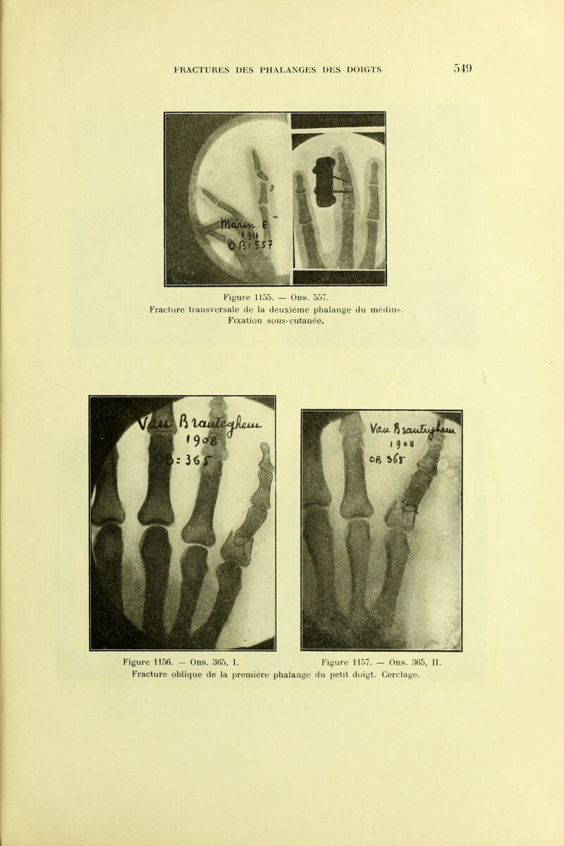 Figure 1156. — Obs. 365, I. Figure 1157. — Obs. 365, II. Fracture oblique de la premiere phalange du petit doigt. Cerclage.