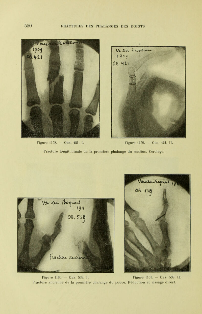 Figure I KiO. — Obs. oSfl, I. I it;iiic I Mil. — Obs. 5311, 11. Fracture ancienne de la premiere phalange du pouce. Reduction et vissage direct.