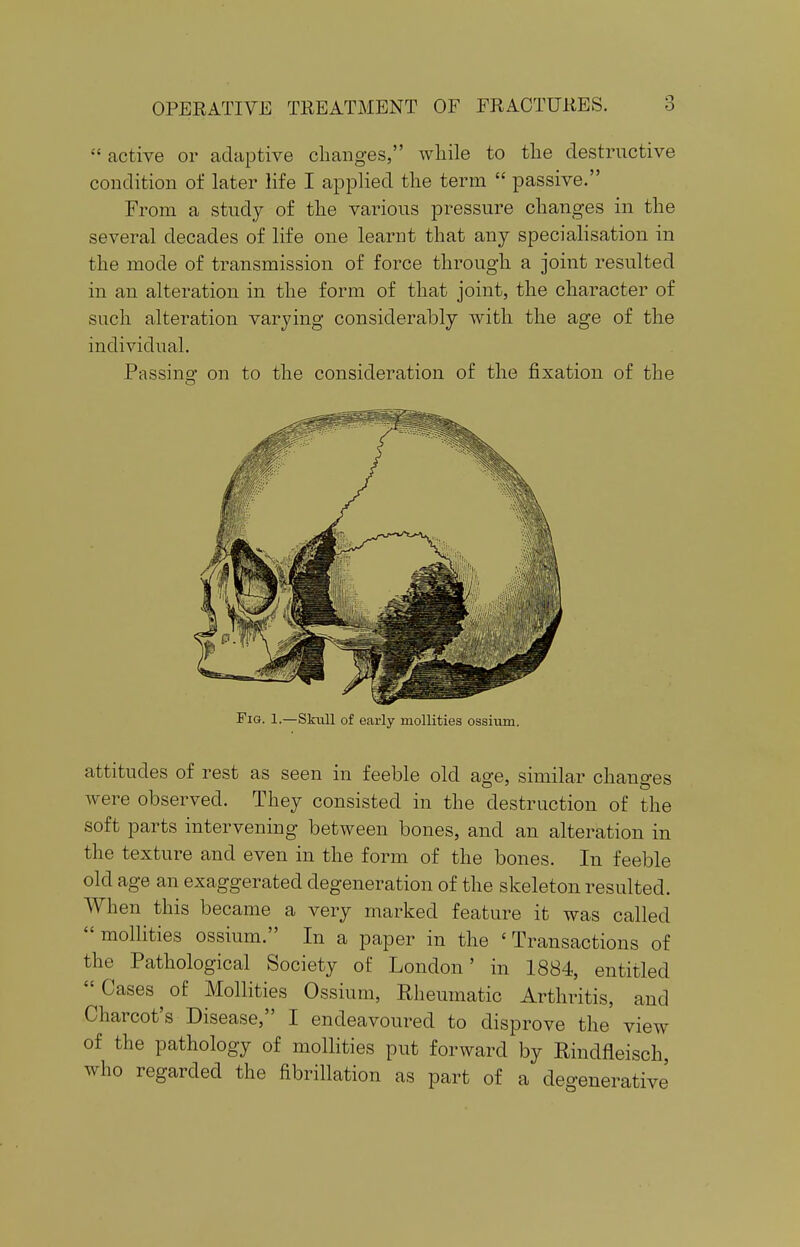  active or adaptive changes, while to the destructive condition of later life I applied the term  passive. From a study of the various pressure changes in the several decades of life one learnt that any specialisation in the mode of transmission of force through a joint resulted in an alteration in the form of that joint, the character of such alteration varying considerably with the age of the individual. Passing on to the consideration of the fixation of the Fig. 1.—Skull of early mollities ossium. attitudes of rest as seen in feeble old age, similar changes were observed. They consisted in the destruction of the soft parts intervening between bones, and an alteration in the texture and even in the form of the bones. In feeble old age an exaggerated degeneration of the skeleton resulted. When this became a very marked feature it was called  mollities ossium. In a paper in the < Transactions of the Pathological Society of London' in 1884, entitled  Cases of Mollities Ossium, Rheumatic Arthritis, and Charcot's Disease, I endeavoured to disprove the view of the pathology of mollities put forward by Rindfleisch, who regarded the fibrillation as part of a degenerative'