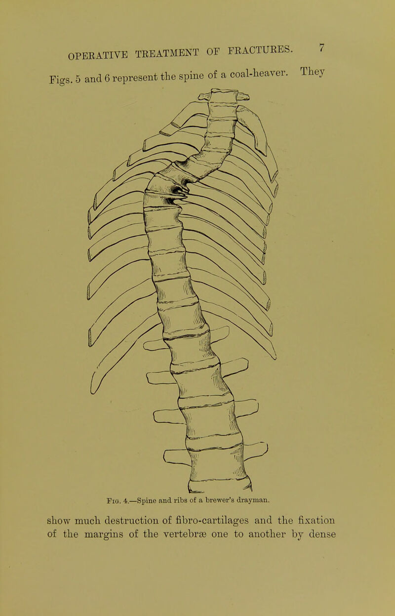 Figs. 5 and 6 represent the spine of a coal-heaver. They Fig. 4.—Spine and ribs of a brewer's drayman. show much destruction of fibro-cartilages and the fixation of the margins of the vertebras one to another by dense