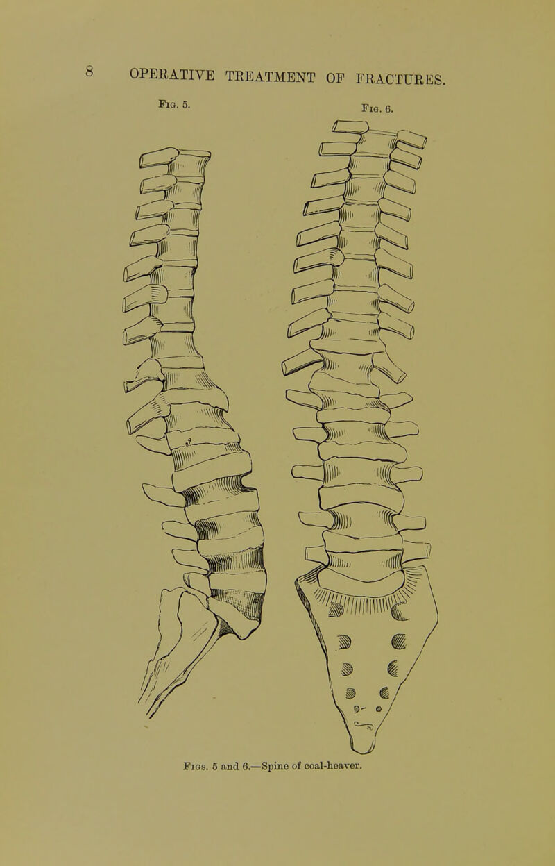 Figs. 5 and 6.—Spine of coal-heaver.