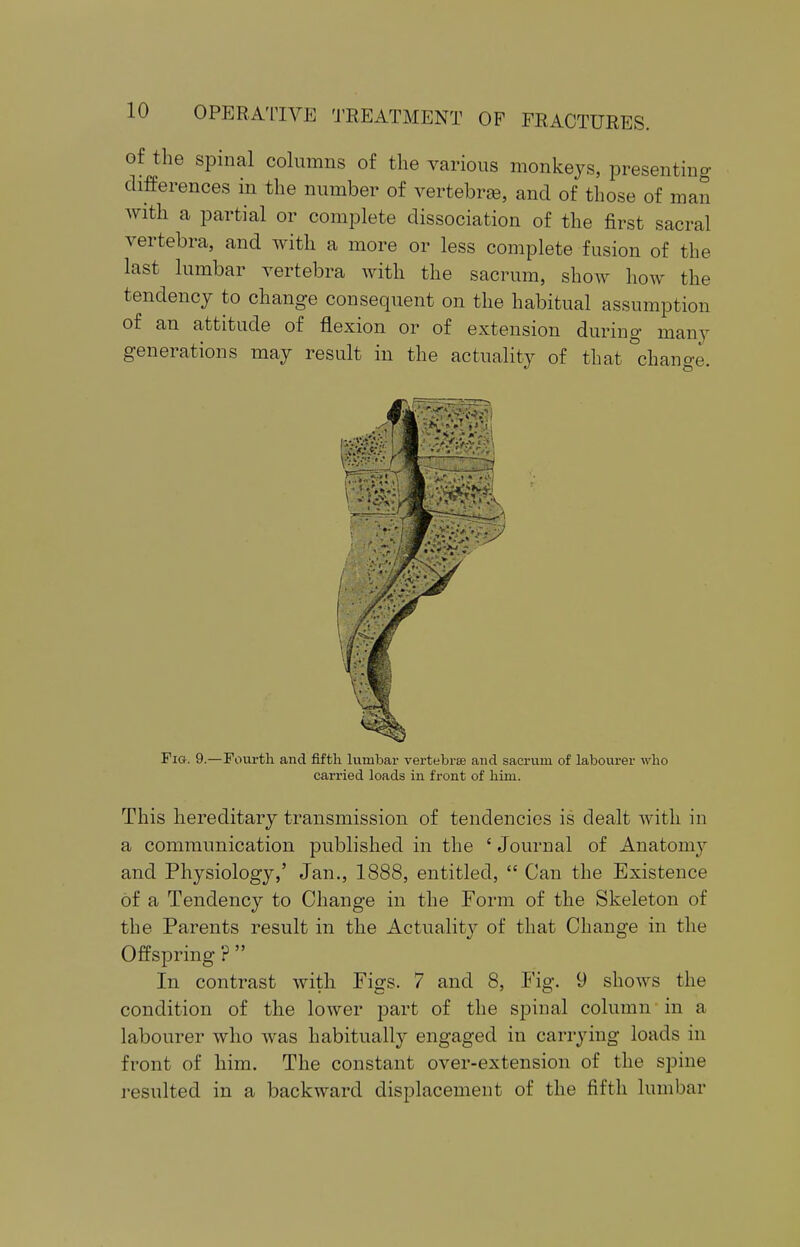 of the spinal columns of the various monkeys, presenting differences in the number of vertebras, and of those of man with a partial or complete dissociation of the first sacral vertebra, and with a more or less complete fusion of the last lumbar vertebra with the sacrum, show how the tendency to change consequent on the habitual assumption of an attitude of flexion or of extension during many generations may result in the actuality of that °change. I- '. V:> 1 - vJV-v • V/V!fy.7/Vi Pig. 9.—Fourth and fifth lumbar vertebrae and sacrum of labourer who carried loads in front of him. This hereditary transmission of tendencies is dealt with in a communication published in the 'Journal of Anatomy and Physiology,' Jan., 1888, entitled,  Can the Existence of a Tendency to Change in the Form of the Skeleton of the Parents result in the Actuality of that Change in the Offspring ?  In contrast with Figs. 7 and 8, Fig. 9 shows the condition of the lower part of the spinal column in a labourer who was habitually engaged in carrying loads in front of him. The constant over-extension of the spine resulted in a backward displacement of the fifth lumbar