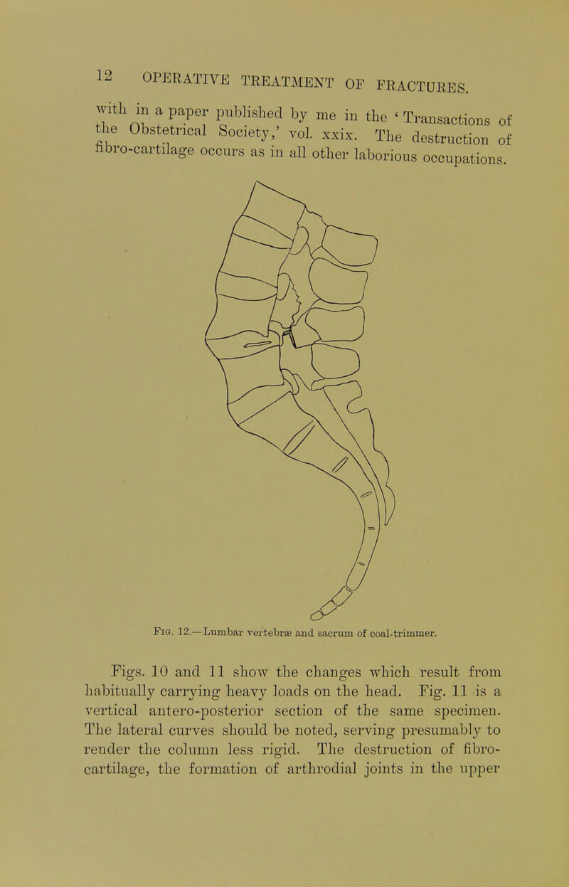 with m a paper published by me in the « Transactions of the Obstetrical Society,' vol. xxix. The destruction of fibro-cartilage occurs as in all other laborious occupations Fig. 12.—Lumbai- vertebrae and sacrum of coal-trimmer. Figs. 10 and 11 show the changes which result from habitually carrying heavy loads on the head. Fig. 11 is a vertical antero-posterior section of the same specimen. The lateral curves should be noted, serving presumably to render the column less rigid. The destruction of fibro- cartilage, the formation of arthrodial joints in the upper