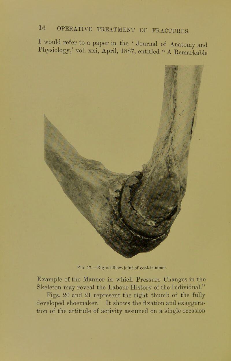 I would refer to a paper in the ' Journal of Anatomy and Physiology,' vol. xxi, April, 1887, entitled A Remarkable Fig. 17.—Eight elbow-joint of coal-trimmer. Example of the Manner in which Pressure Changes in the Skeleton may reveal the Labour History of the Individual. Figs. 20 and 21 represent the right thumb of the fully developed shoemaker. It shows the fixation and exaggera- tion of the attitude of activity assumed on a single occasion