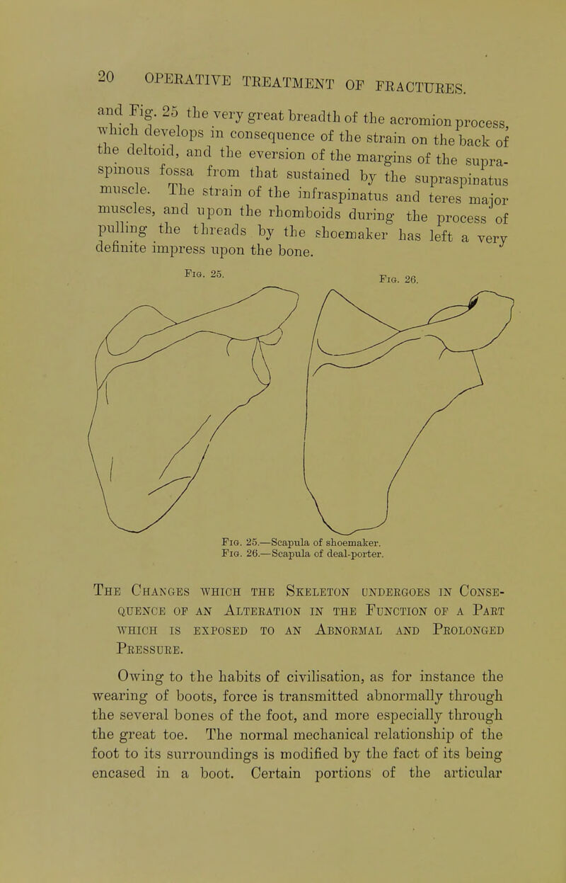 and Fig. 2o the very great breadth of the acromion process which develops m consequence of the strain on the back of the deltoid, and the eversion of the margins of the supra- spinous fossa from that sustained by the supraspinous muscle. The strain of the infraspinatus and teres major muscles, and upon the rhomboids during the process of pulling the threads by the shoemaker has left a very definite impress upon the bone. Fig. 25. Fig. 26. Fig. 25.—Scapula of shoemaker. Fig. 26.—Scapula of deal-porter. The Changes which the Skeleton undergoes in Conse- quence of an Alteration in the Function of a Part which is exposed to an abnormal and prolonged Pressure. Owing to the habits of civilisation, as for instance the wearing of boots, force is transmitted abnormally through the several bones of the foot, and more especially through the great toe. The normal mechanical relationship of the foot to its surroundings is modified by the fact of its being encased in a boot. Certain portions of the articular