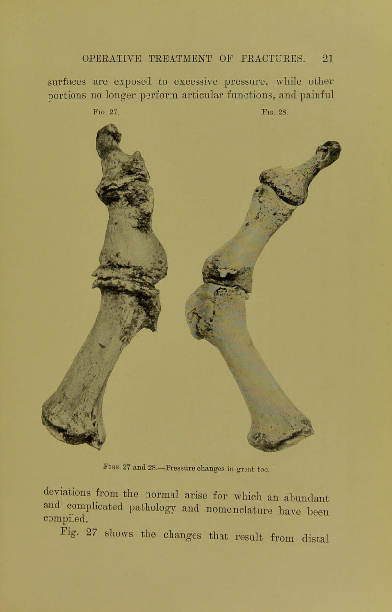 surfaces are exposed to excessive pressure, while other portions no longer perform articular functions, and painful Fig. 27. Fig. 28. Figs. 27 and 28.—Pressure changes in great toe. deviations from the normal arise for which an abundant and complicated pathology and nomenclature have been compiled. Fig. 27 shows the changes that result from distal