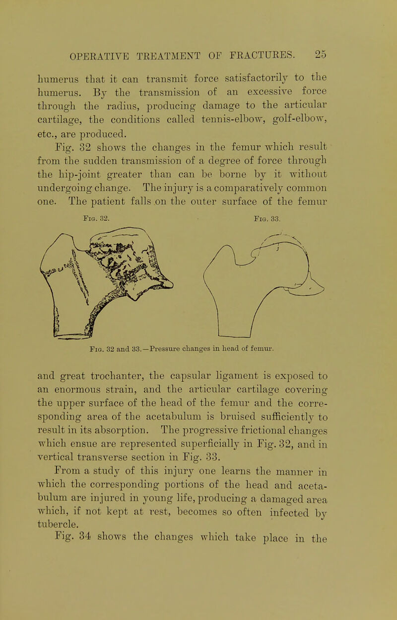 humerus that it can transmit force satisfactorily to the humerus. By the transmission of an excessive force through the radius, producing damage to the articular cartilage, the conditions called tennis-elbow, golf-elbow, etc., are produced. Fig. 32 shows the changes in the femur which result from the sudden transmission of a degree of force through the hip-joint greater than can be borne by it without undergoing change. The injury is a comparatively common one. The patient falls on the outer surface of the femur Fig. 32. Fig. 33. Fig. 32 and 33.—Pressure changes in head of femur. and great trochanter, the capsular ligament is exposed to an enormous strain, and the articular cartilage covering the upper surface of the head of the femur and the corre- sponding area of the acetabulum is bruised sufficiently to result in its absorption. The progressive frictional changes which ensue are represented superficially in Fig. 32, and in vertical transverse section in Fig. 33. From a study of this injury one learns the manner in which the corresponding portions of the head and aceta- bulum are injured in young life, producing a damaged area which, if not kept at rest, becomes so often infected by tubercle. Fig. 34 shows the changes which take place in the