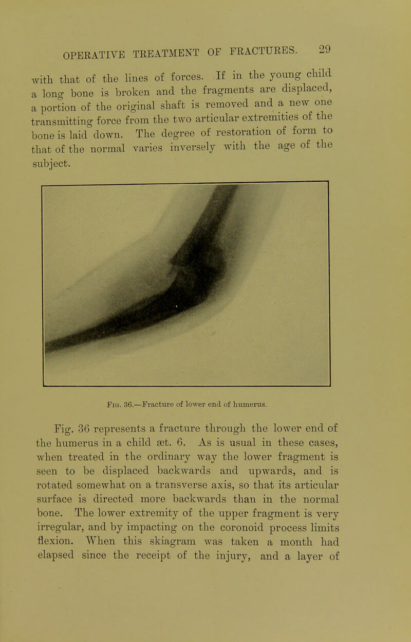 with that of the lines of forces. If in the young child a long bone is broken and the fragments are displaced, a portion of the original shaft is removed and a new one transmitting force from the two articular extremities of the bone is laid down. The degree of restoration of form to that of the normal varies inversely with the age of the subject. Fm. 36.—Fracture of lower end of humerus. Fig. 36 represents a fracture through the lower end of the humerus in a child set. 6. As is usual in these cases, when treated in the ordinary way the lower fragment is seen to be displaced backwards and upwards, and is rotated somewhat on a transverse axis, so that its articular surface is directed more backwards than in the normal bone. The lower extremity of the upper fragment is very irregular, and by impacting on the coronoid process limits flexion. When this skiagram was taken a month had elapsed since the receipt of the injury, and a layer of