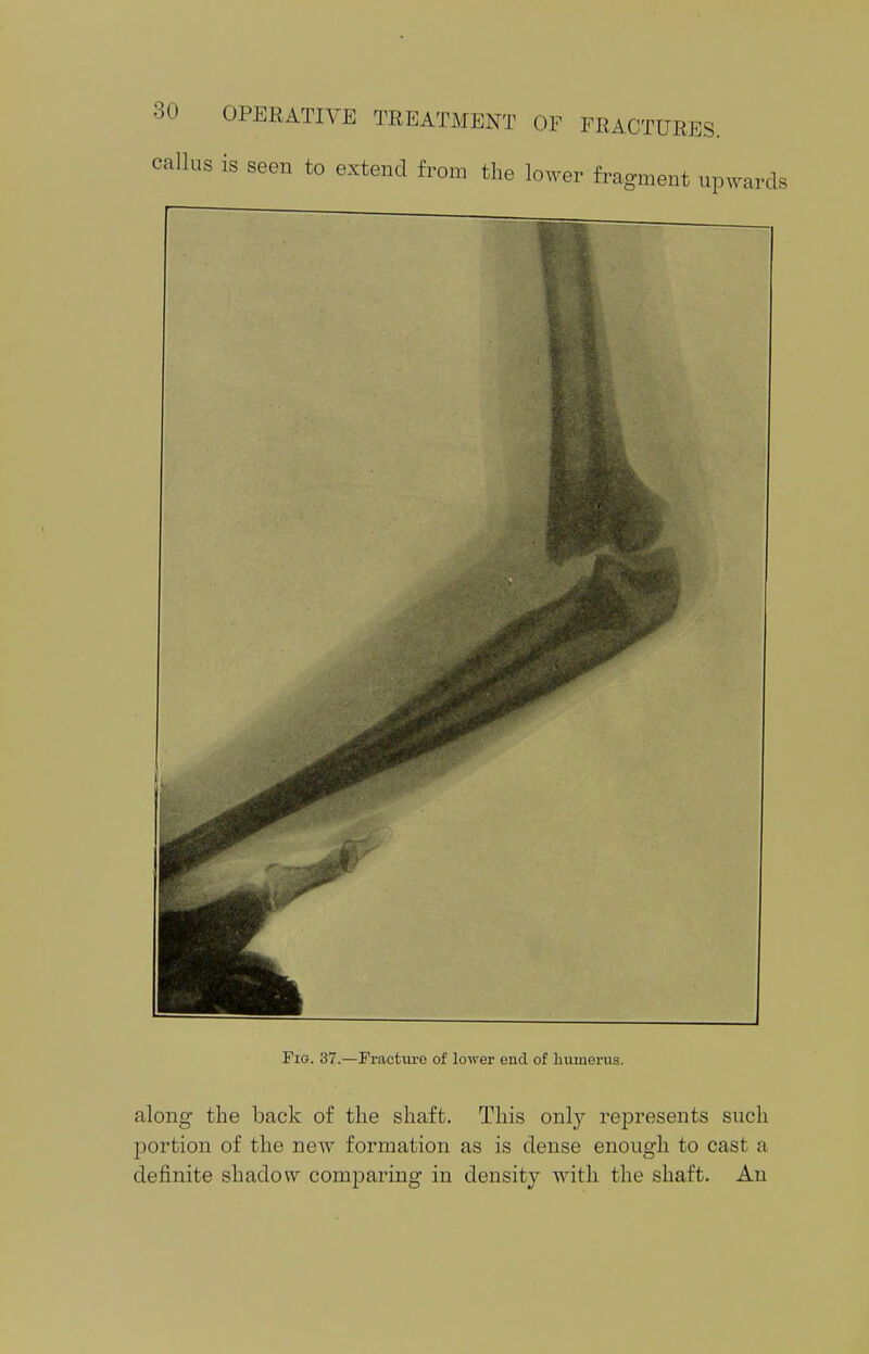 callus is seen to extend from the lower fragment upwards Fig. 37.—Fracture of lower end of humerus. along the back of the shaft. This only represents such portion of the new formation as is dense enough to casi a definite shadow comparing in density with the shaft. An