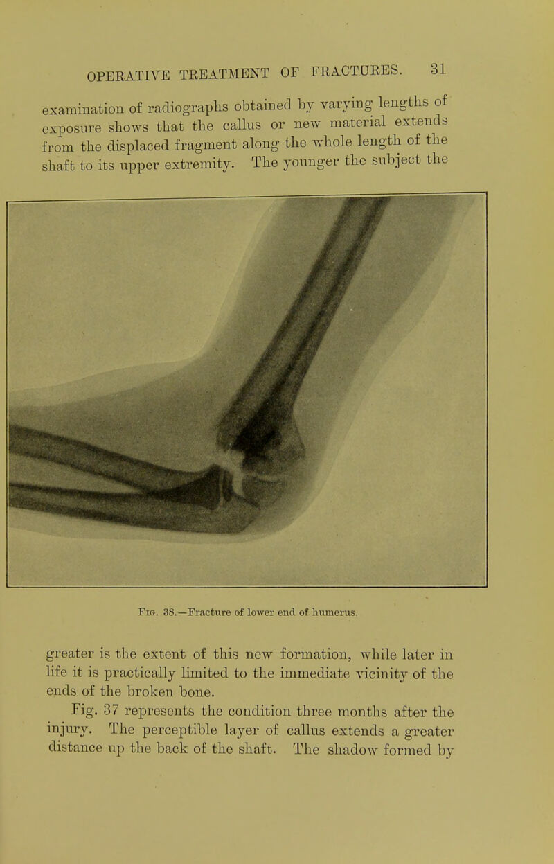 examination of radiographs obtained by varying lengths of exposure shows that the callus or new material extends from the displaced fragment along the whole length of the shaft to its upper extremity. The younger the subject the Fig. 38.—Fracture of lower end of humerus. greater is the extent of this new formation, while later in life it is practically limited to the immediate vicinity of the ends of the broken bone. Fig. 37 represents the condition three months after the injury. The perceptible layer of callus extends a greater distance up the back of the shaft. The shadow formed by