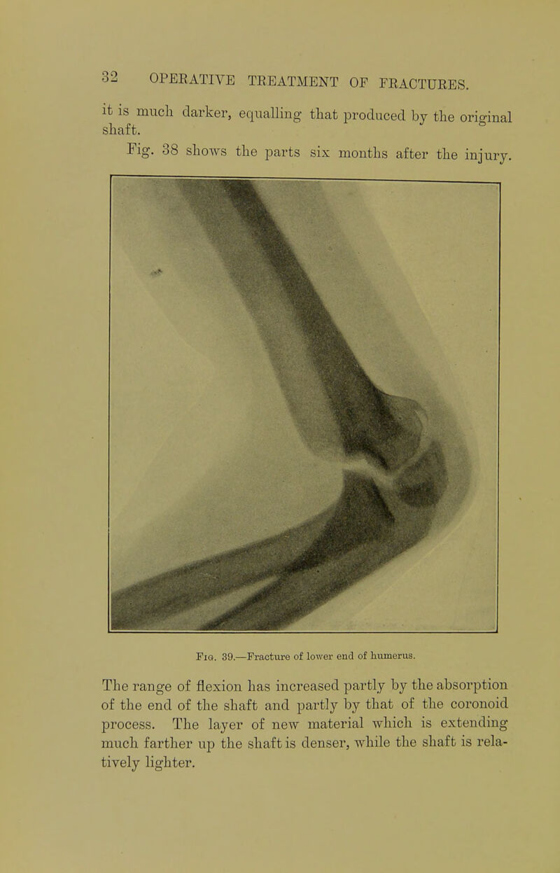 it is much darker, equalling that produced by the original shaft. Fig. 38 shows the parts six months after the injury. Fig. 39.—Fracture of lower end of humerus. The range of flexion has increased partly by the absorption of the end of the shaft and partly by that of the coronoid process. The layer of new material which is extending much farther up the shaft is denser, while the shaft is rela- tively lighter.