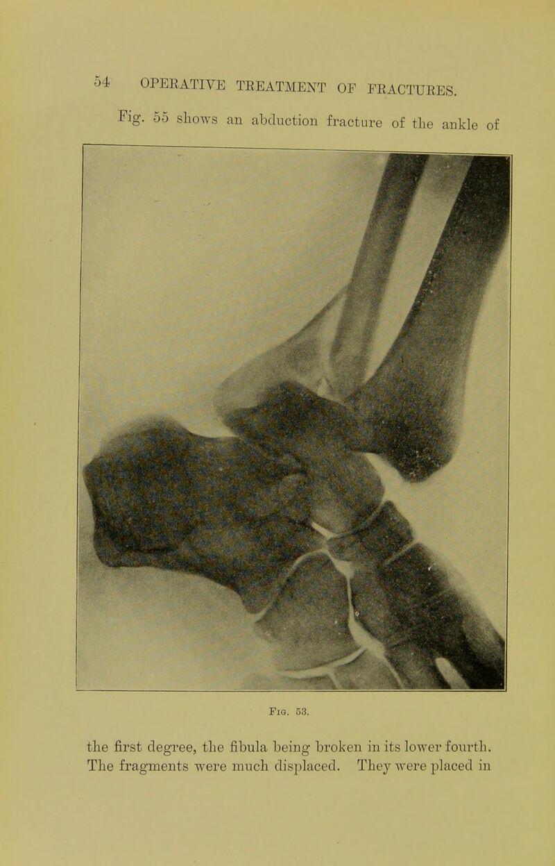 Fig. 55 shows an abduction fracture of the ankle of Fig. 53. the first degree, the fibula being broken in its lower fourth. The fragments were much displaced. They were placed in