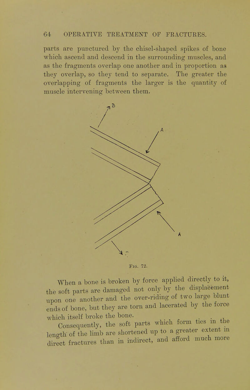 parts are punctured by the chisel-shaped spikes of bone which ascend and descend in the surrounding muscles, and as the fragments overlap one another and in proportion as they overlap, so they tend to separate. The greater the overlapping of fragments the larger is the quantity of muscle intervening between them. Fig. 72. When a bone is broken by force applied directly to it, the soft parts are damaged not only by the displacement upon one another and the over-riding of two large blunt ends of bone, but they are torn and lacerated by the force which itself broke the bone. . Consequently, the soft parts which form ties m the length of the limb are shortened up to a greater extent m direct fractures than in indirect, and afford much more